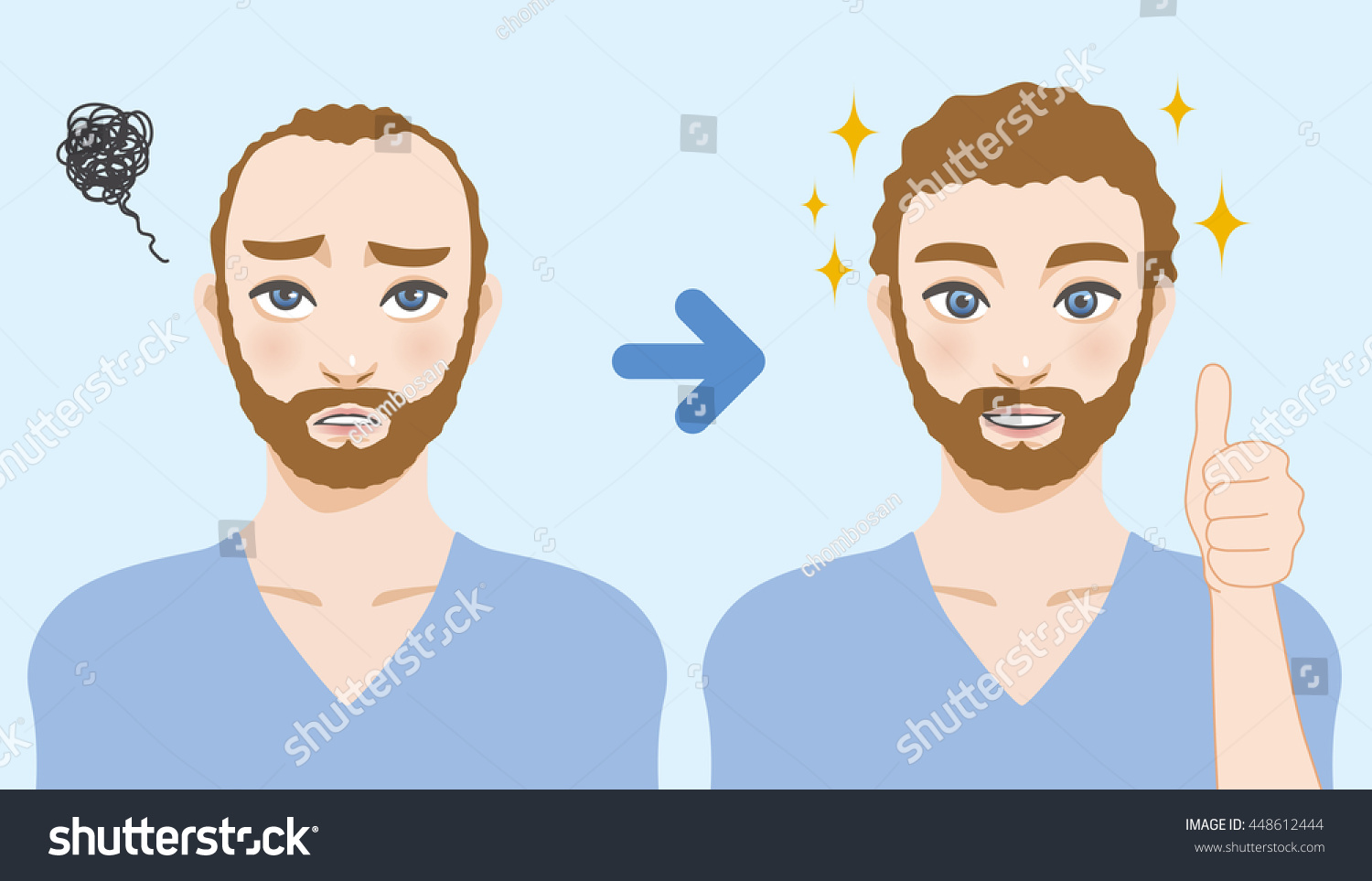 Mens Thinning Hair Treatment Before After Stock Vector Royalty