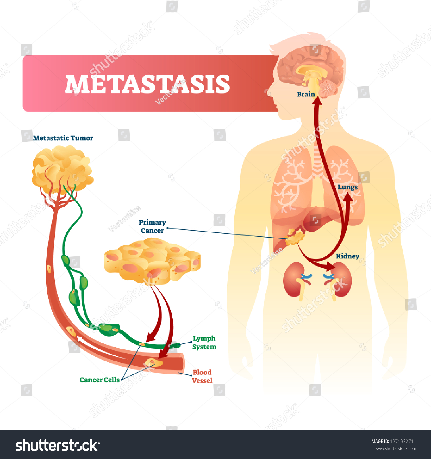 Metastasis Vector Illustration Primary Cancer Tumor 库存矢量图 免版税 1271932711