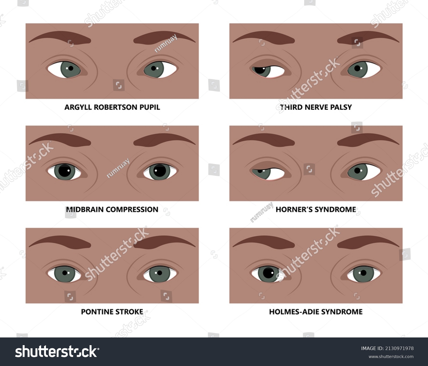 Miosis Eye Pupil Size Iris Retina Stock Vector (Royalty Free ...