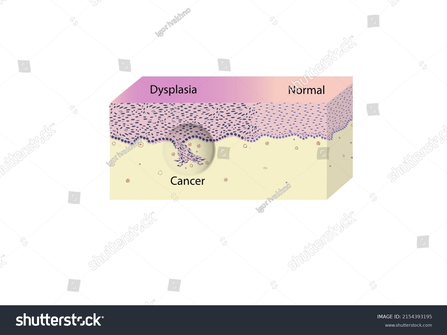 Morphology Cervical Cancer Dysplasia Under Microscope Stock Vector Royalty Free 2154393195 