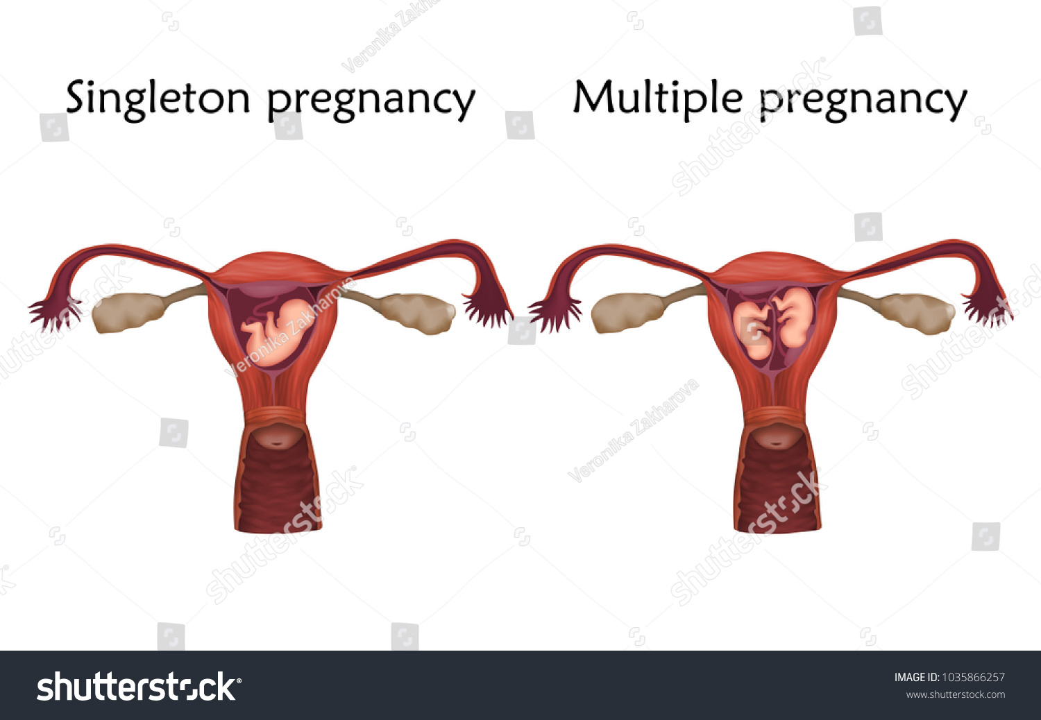 multiple-singleton-pregnancy-twins-embryo-fetus-stock-vector-royalty-free-1035866257