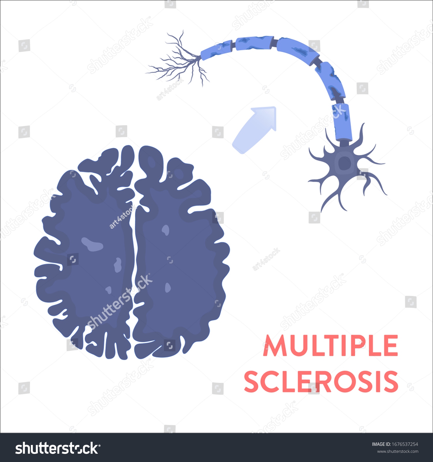 Multiple Sclerosis Awareness Illustration Mri Scan Stock Vector 