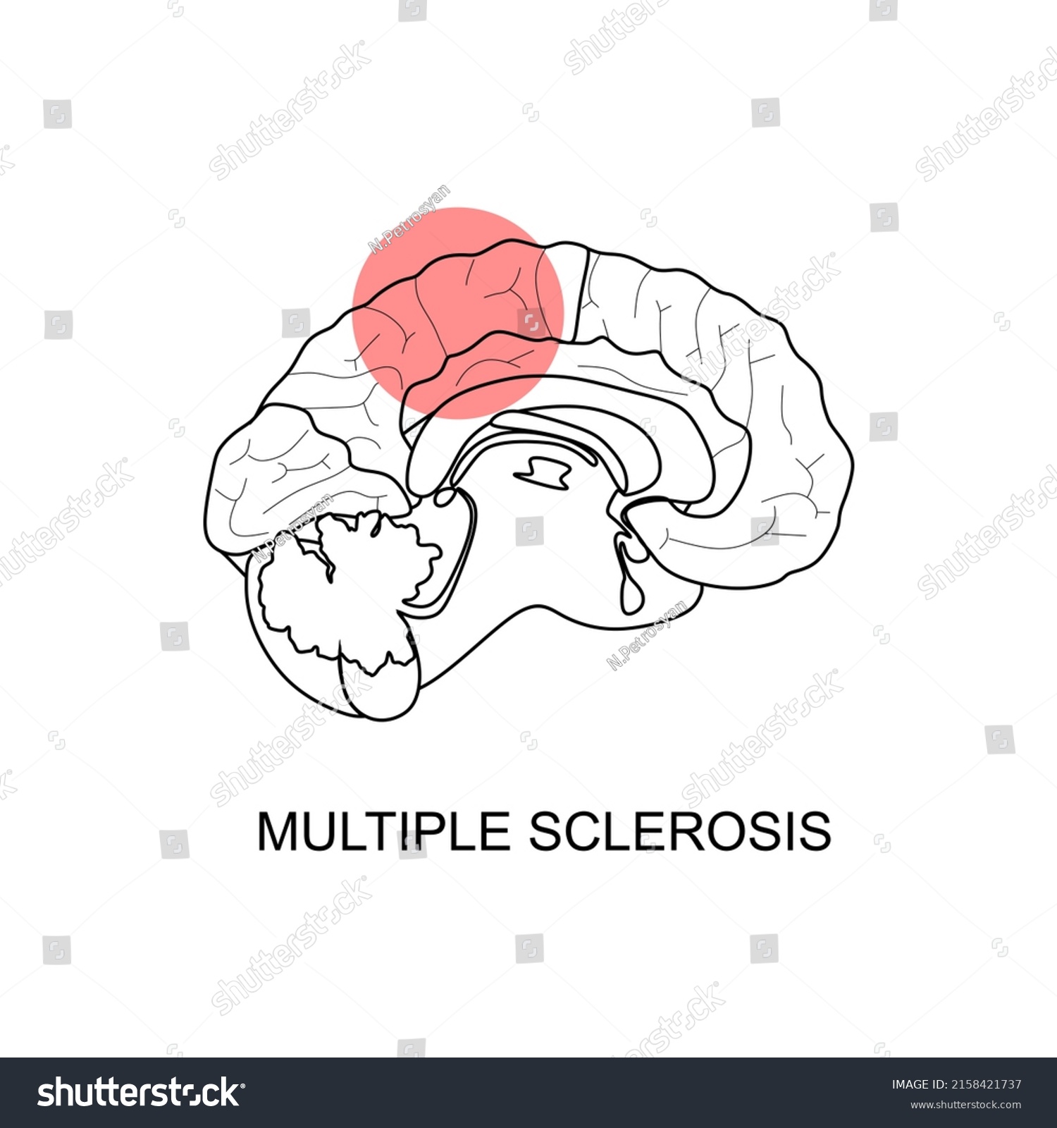 Multiple Sclerosis Icon Multiple Sclerosis Symbol Stock Vector (Royalty ...