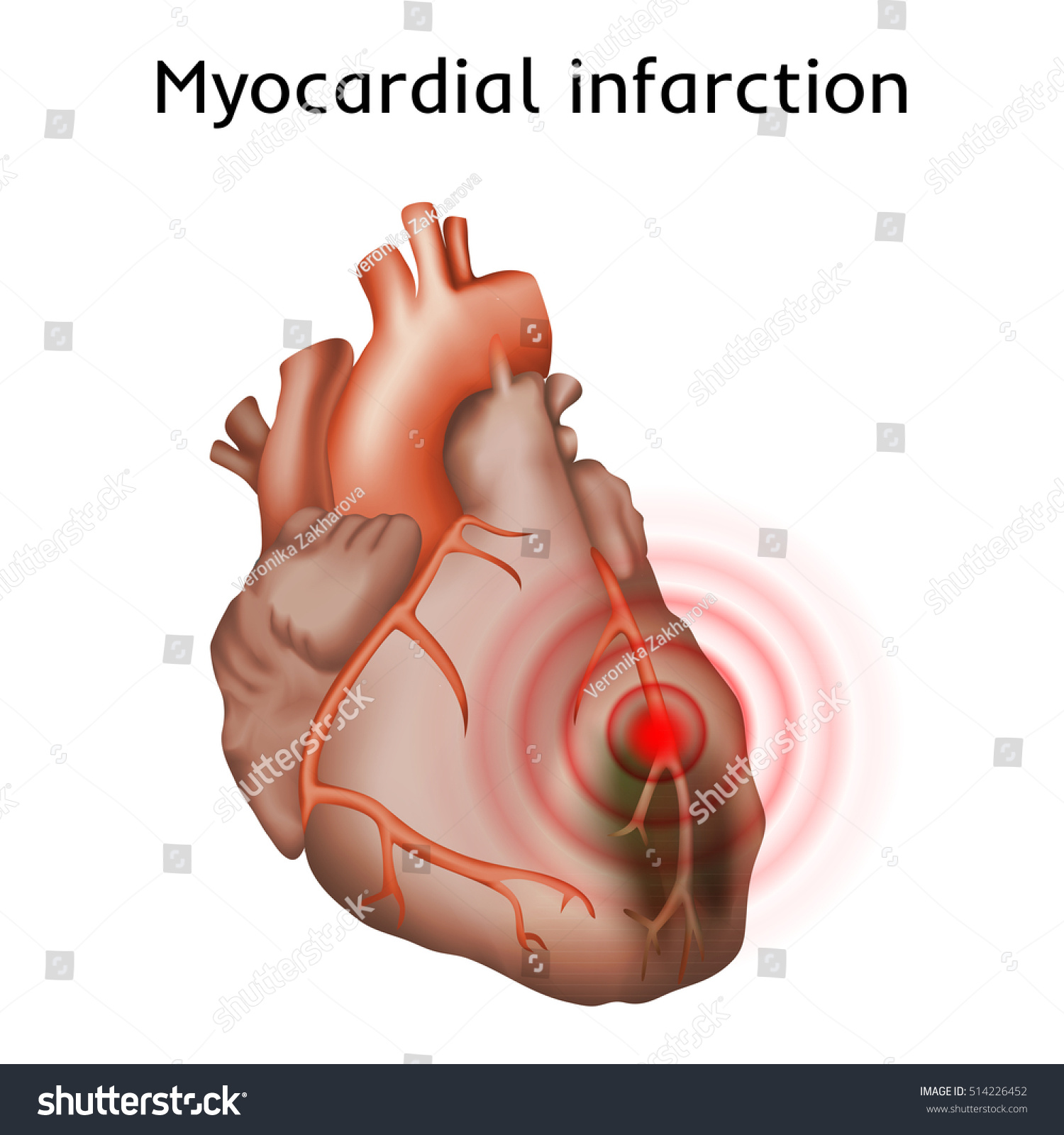 Myocardial Infarction Heart Attack Pain Damaged Stock Vector Royalty Free 514226452