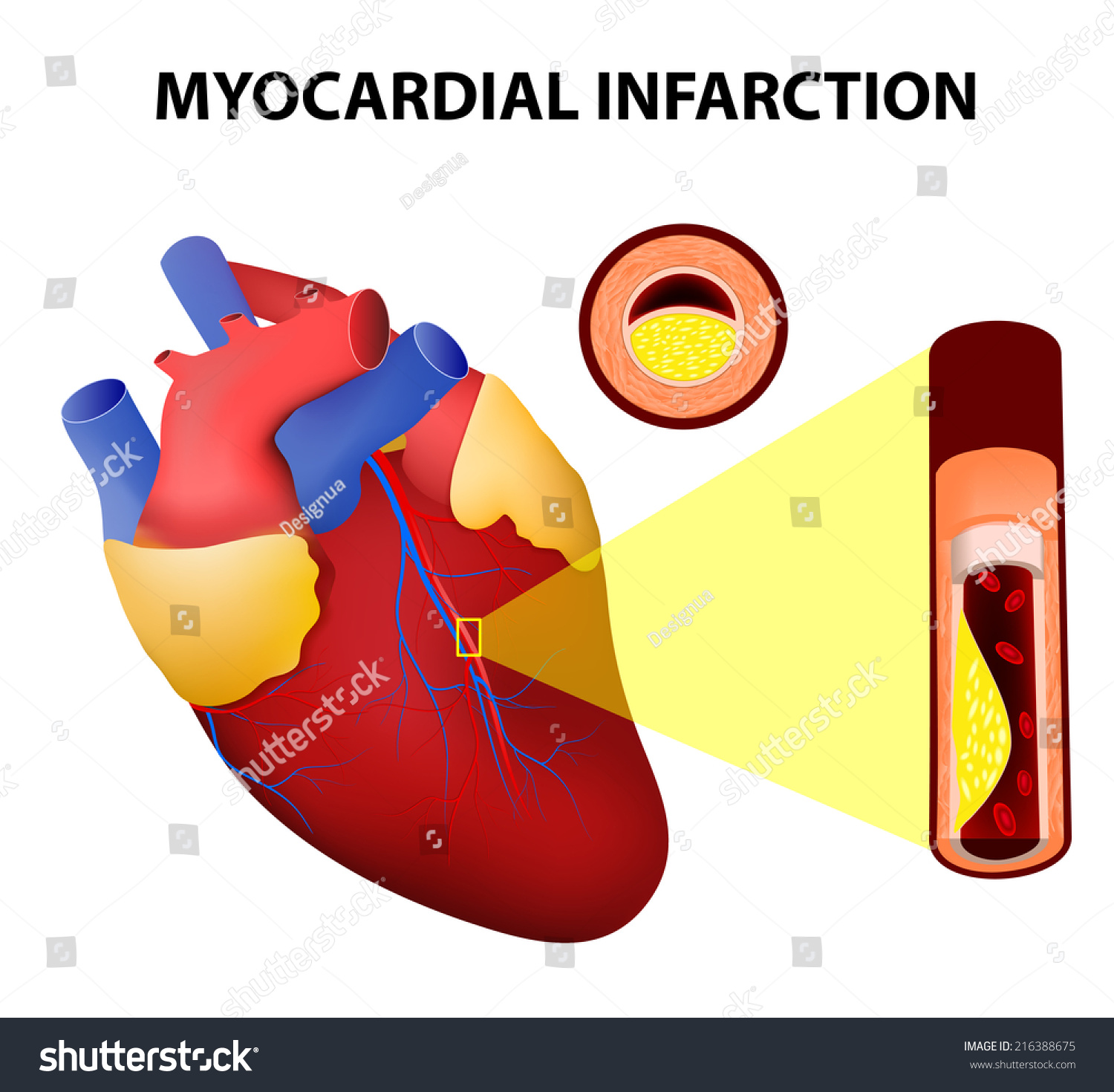 Myocardial Infarction Or Heart Attack Stock Vector Illustration