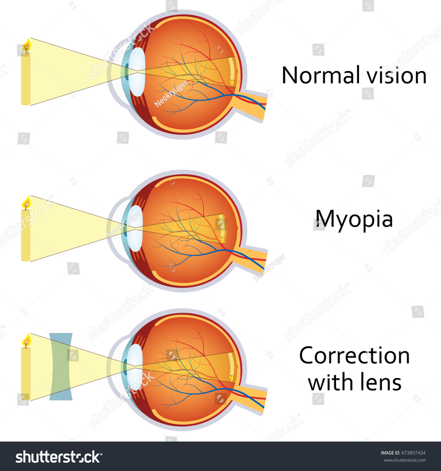 tartósan kitágult pupilla myopia
