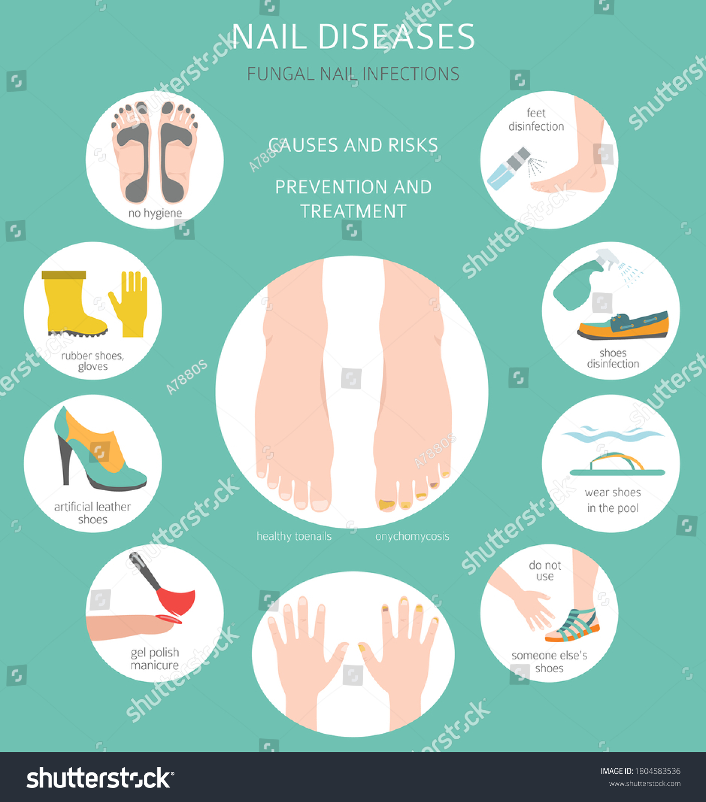 Nail Diseases Onychomycosis Nail Fungal Infection Stock Vector Royalty Free 1804583536 