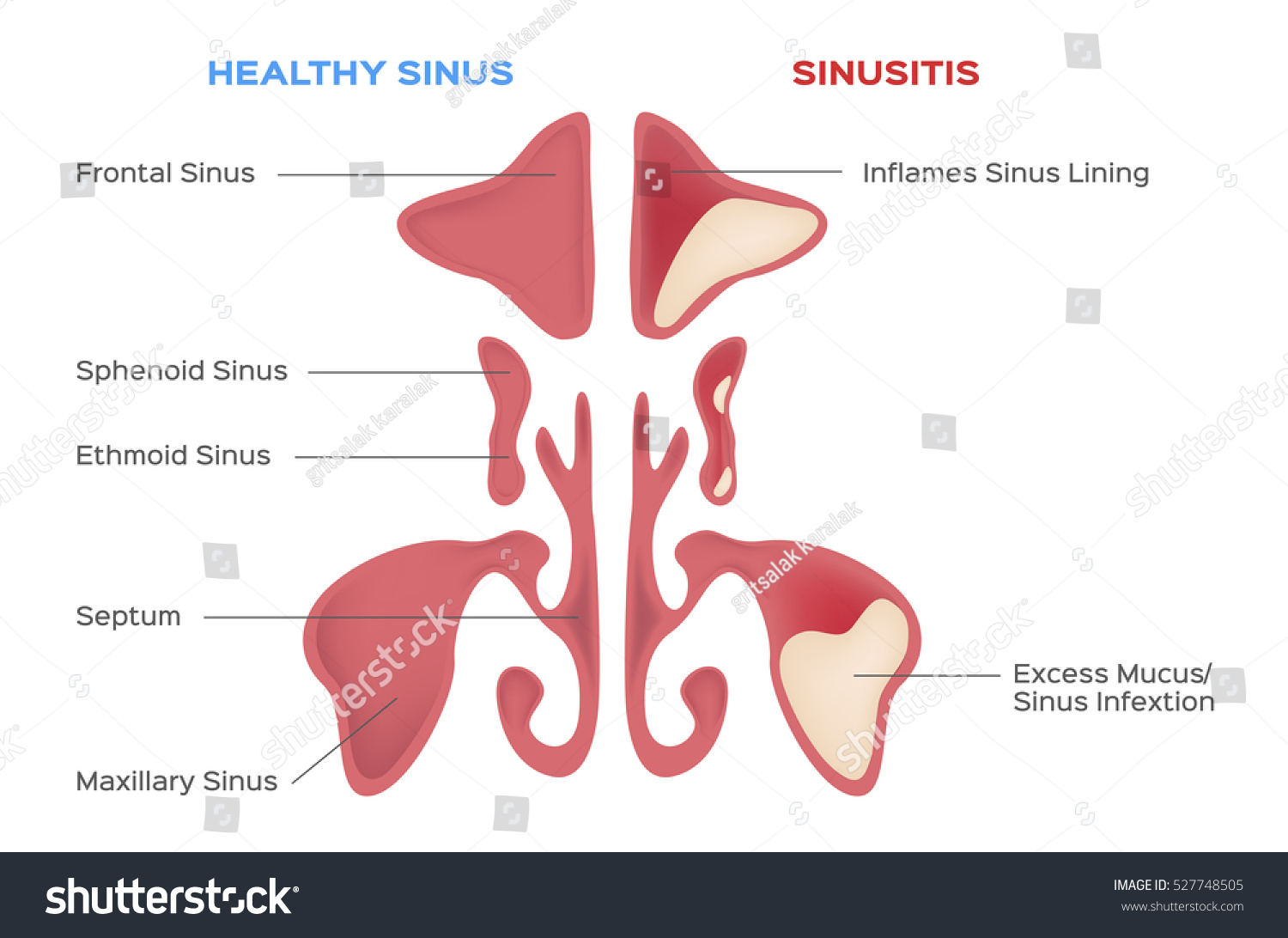 Nasal Sinus Healthy Inflammation Vector Stock Vector (Royalty Free ...