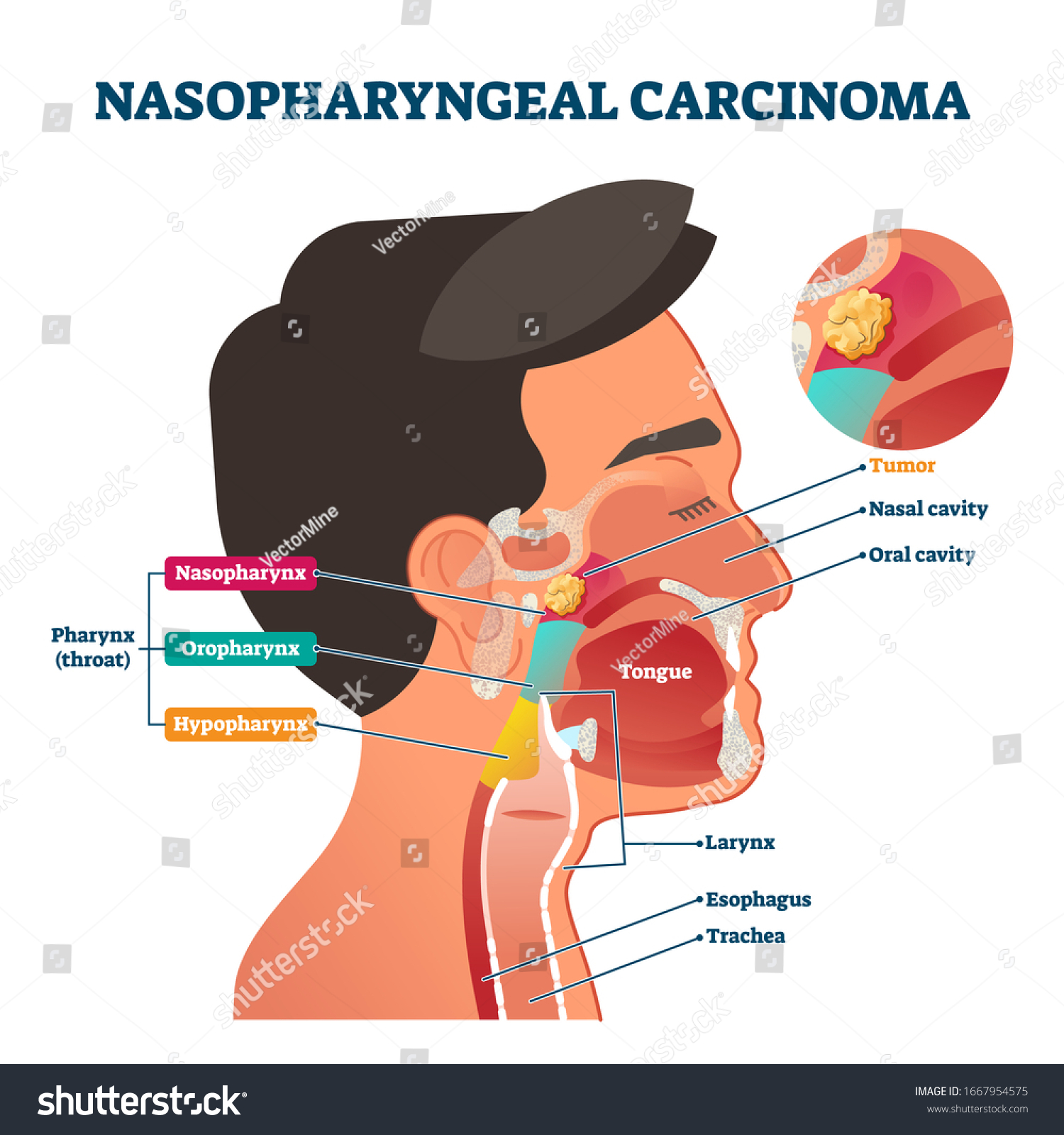 Nasopharyngeal Carcinoma Tumor Vector Illustration Labeled Stock Vector ...