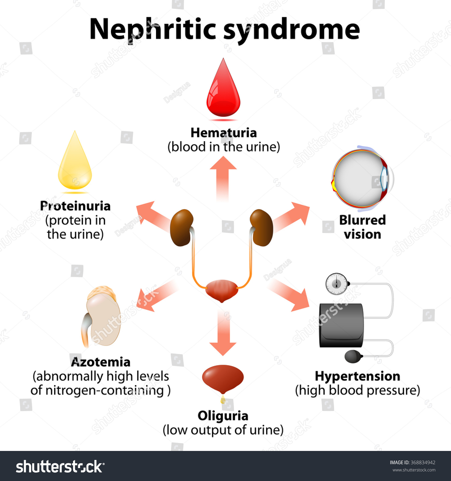 Nephritic Syndrome Or Acute Nephritic Syndrome. Kidneys Disease Stock ...