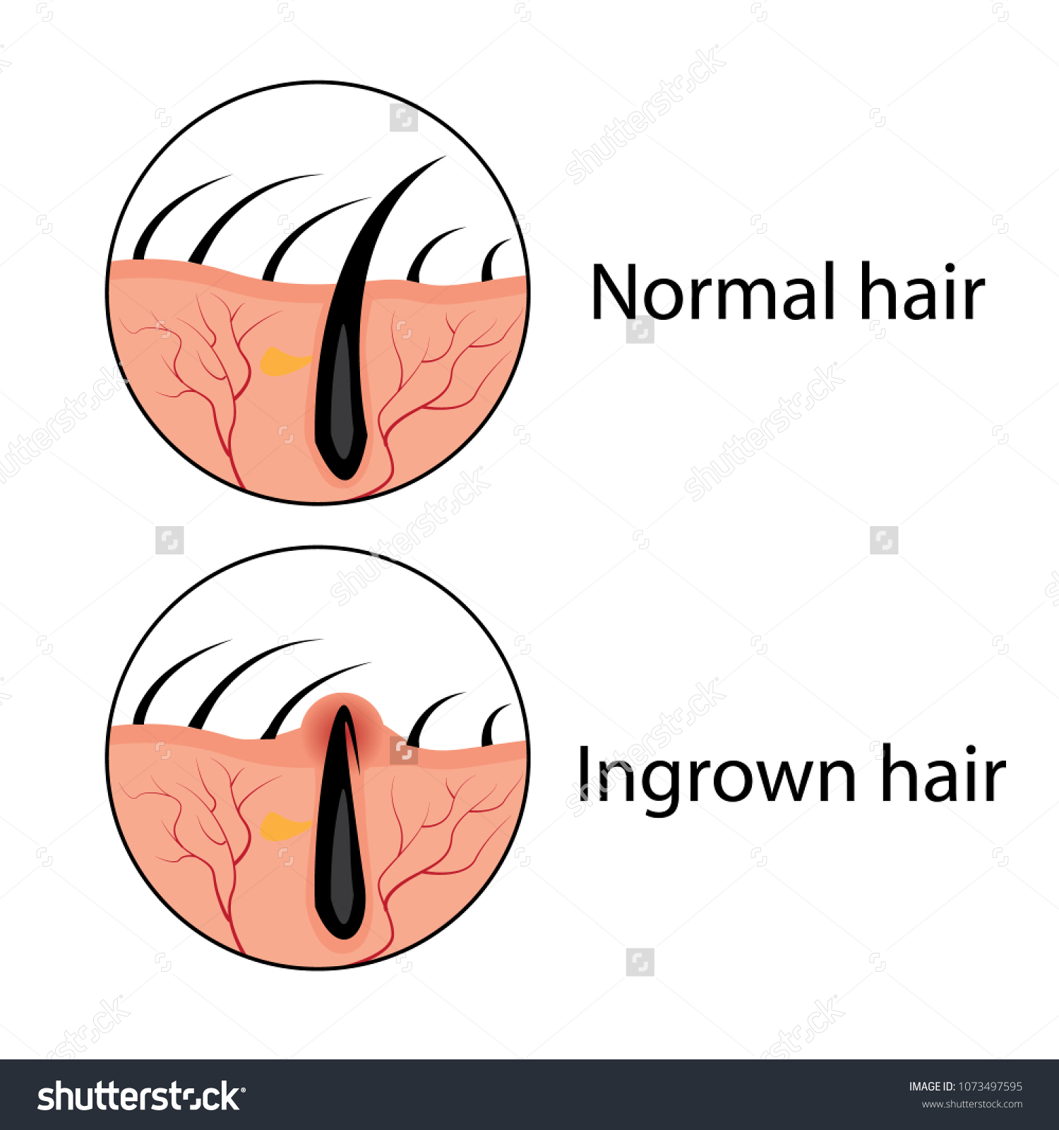 Normal Ingrown Hair Vector Illustration Skincare Stock Vector (Royalty ...