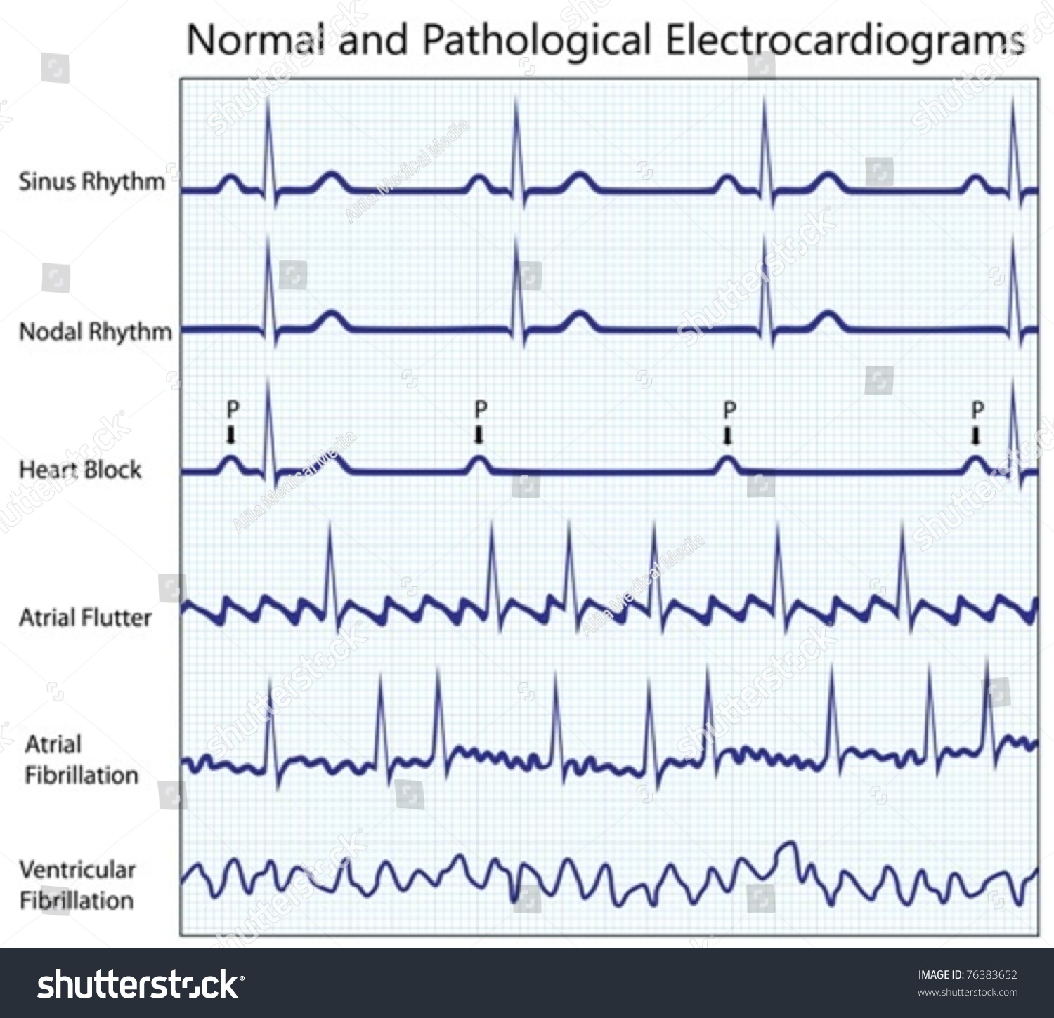 Normal Pathological Ecg Collection Stock Vector 76383652 - Shutterstock