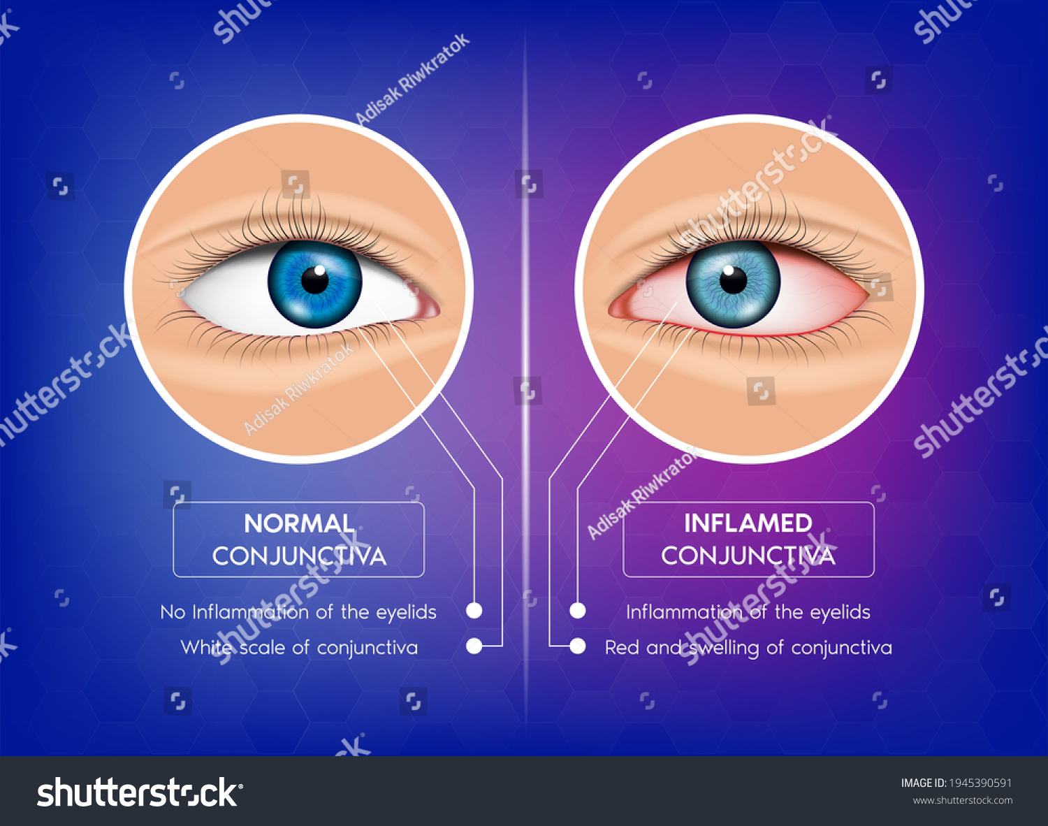 Normal Conjunctiva Conjunctivitis Human Eye Anatomy Vector Có Sẵn Miễn Phí Bản Quyền 