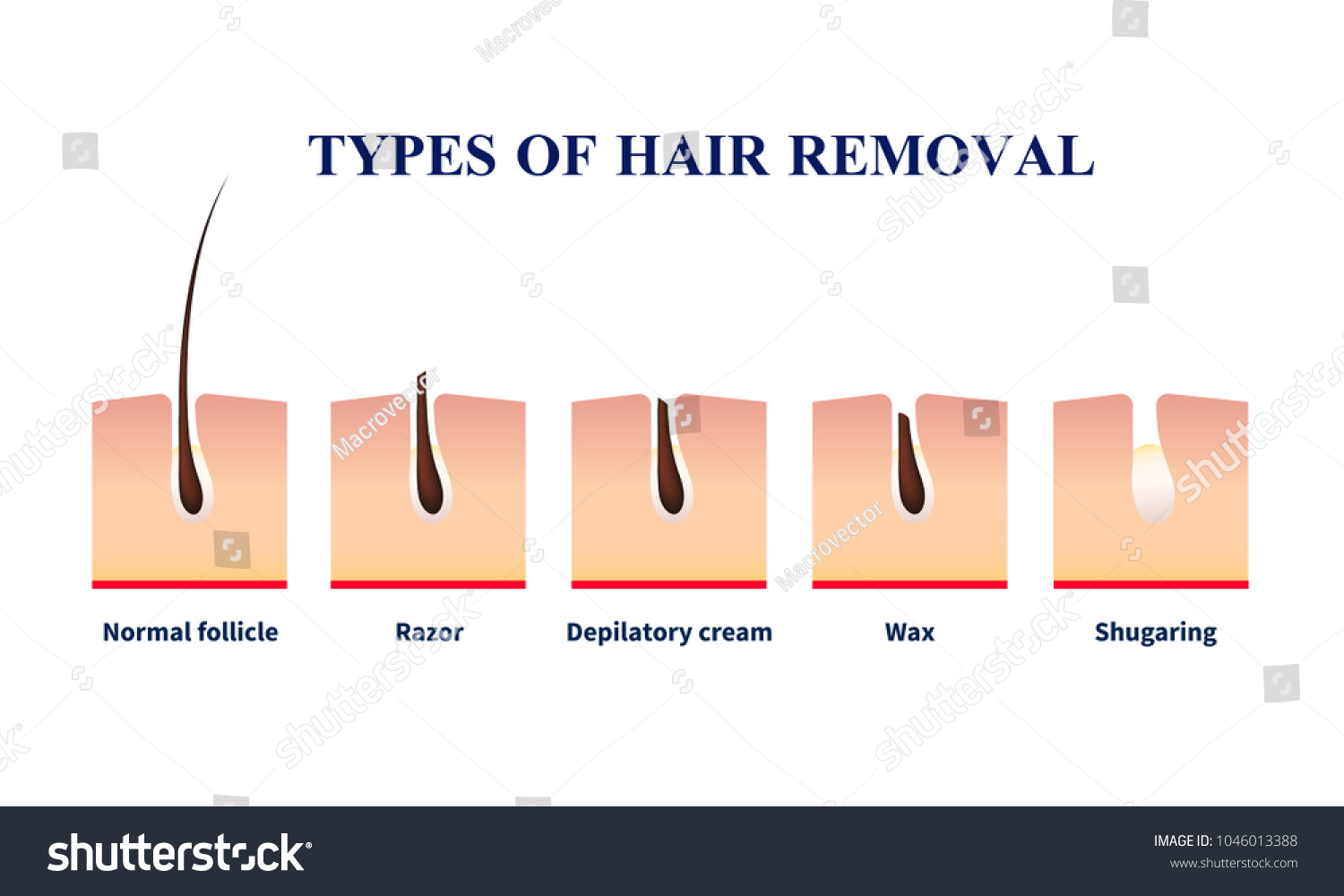 Normal Follicle Types Hair Removal Help Stock Vector Royalty Free