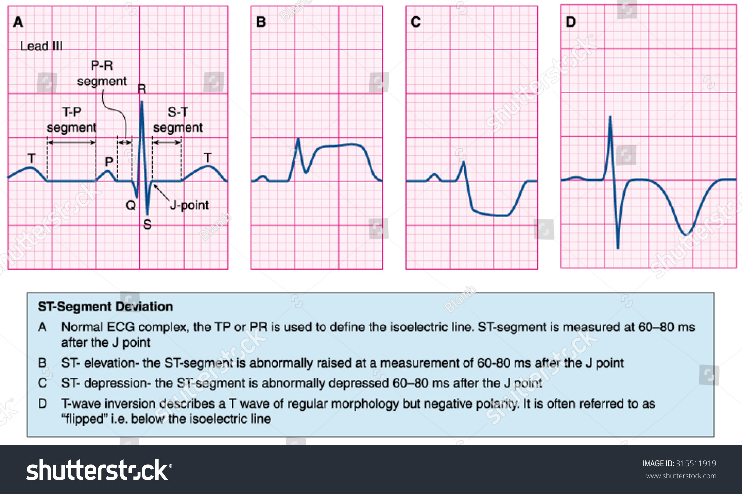 Normal Heart Ecg Trace Compared Abnormal Stock Vector (Royalty Free ...