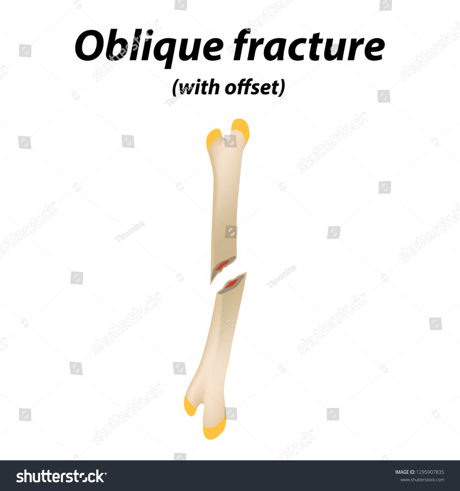 Oblique Offset Bone Fracture Infographics Vector Stock Vector Royalty Free 1295907835