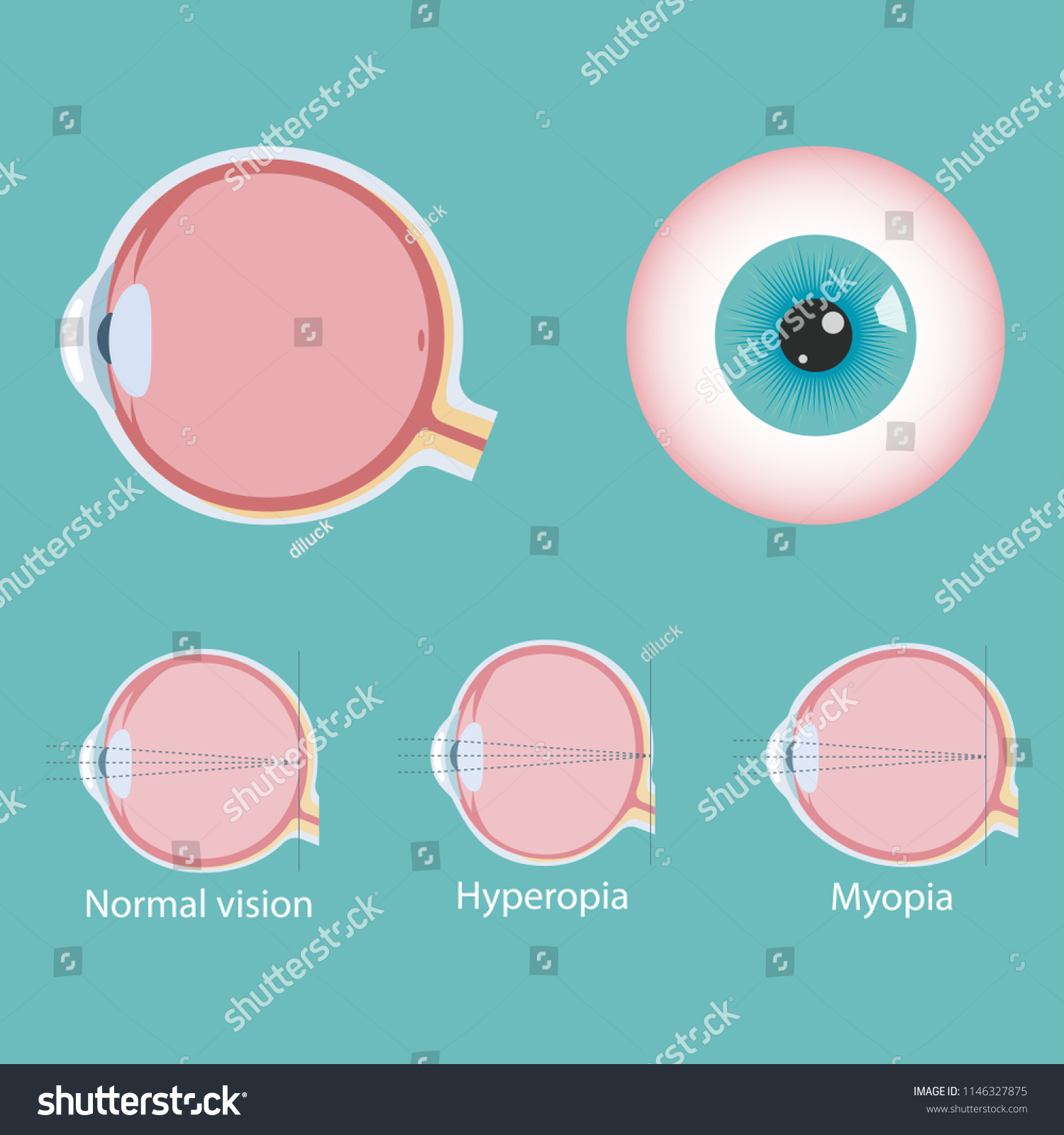 Ophthalmic Concept Eye Defects Normal Vision Stock Vector (Royalty Free ...