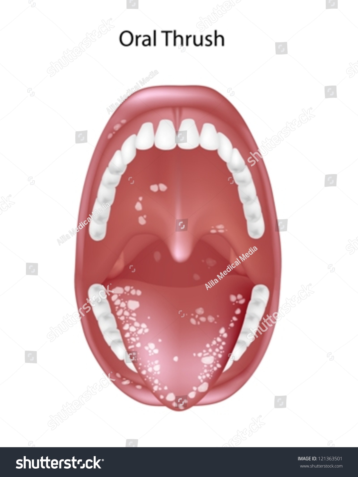 Oral Thrush Candidiasis Stock Vector 121363501 - Shutterstock