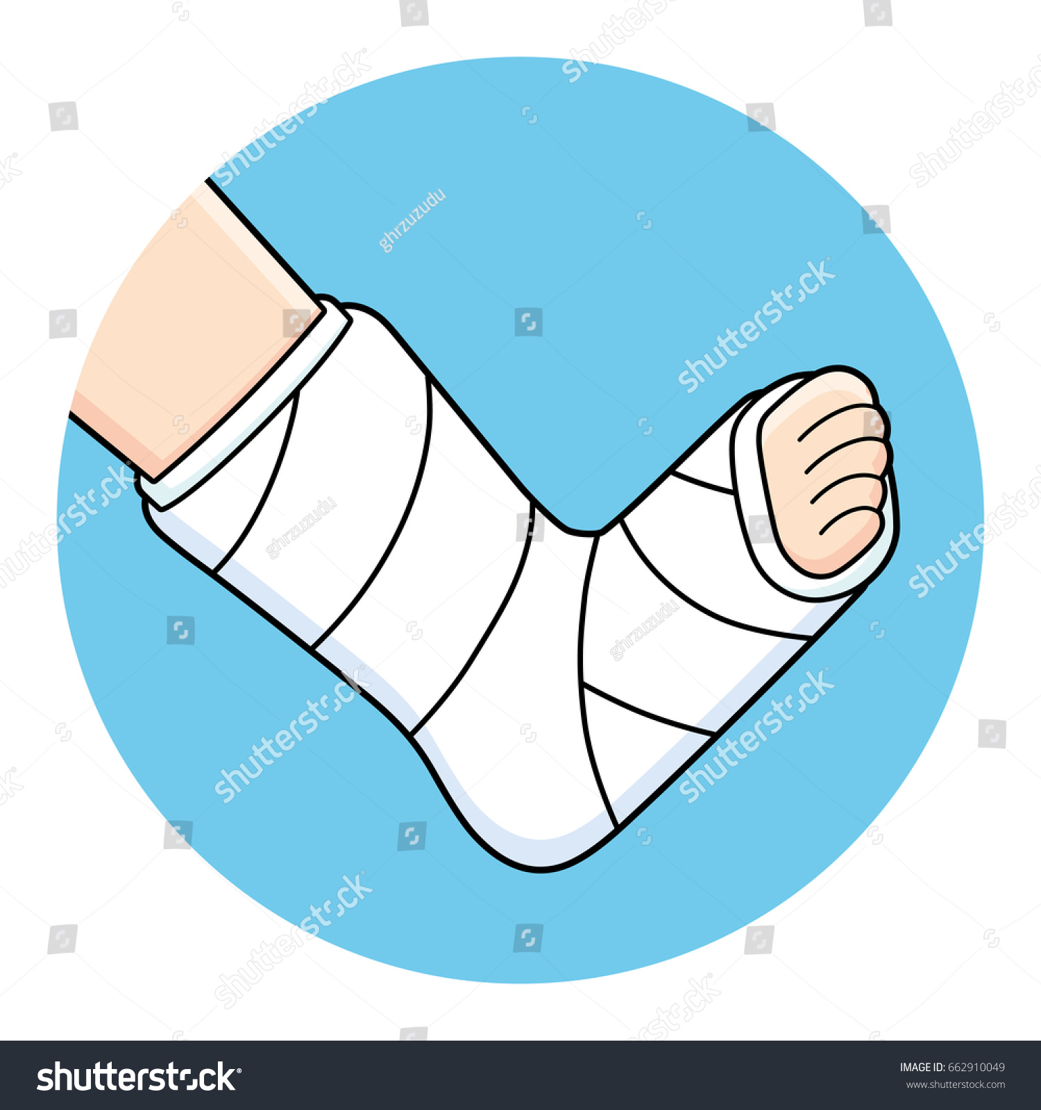 SVG of Orthopedic plaster or fiberglass cast, broken leg, bone fracture, vector icon. svg