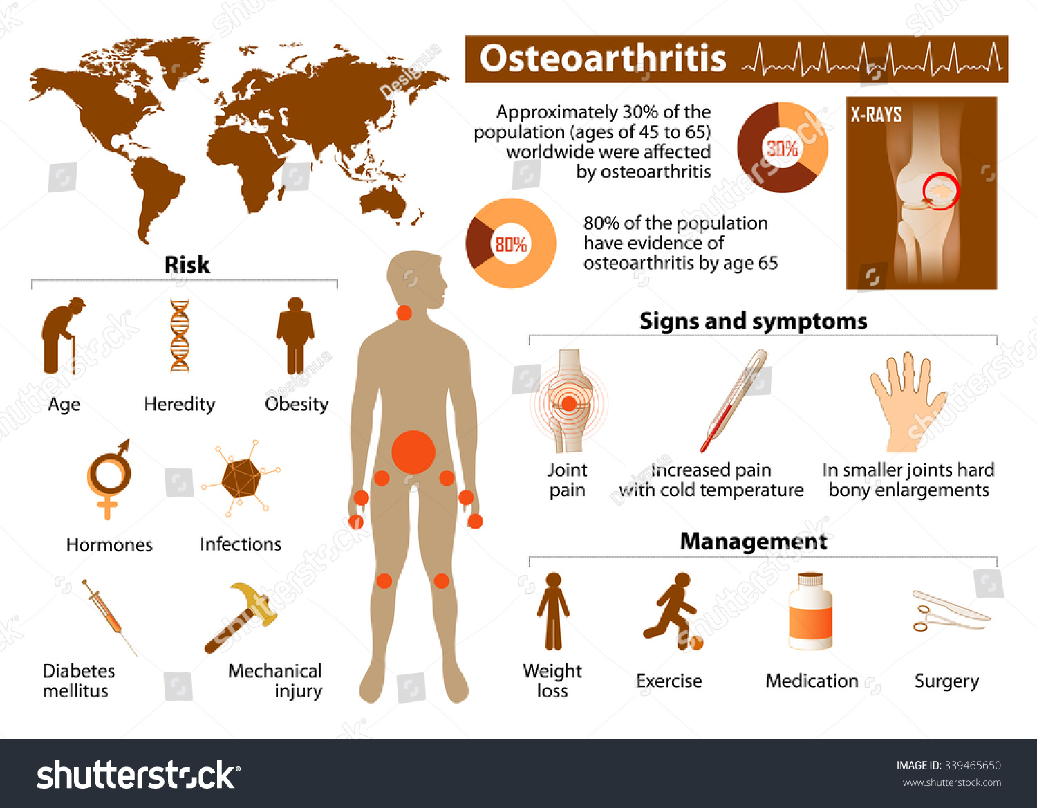 Osteoarthritis. Medical Infographic Set With Icons And Other Elements ...