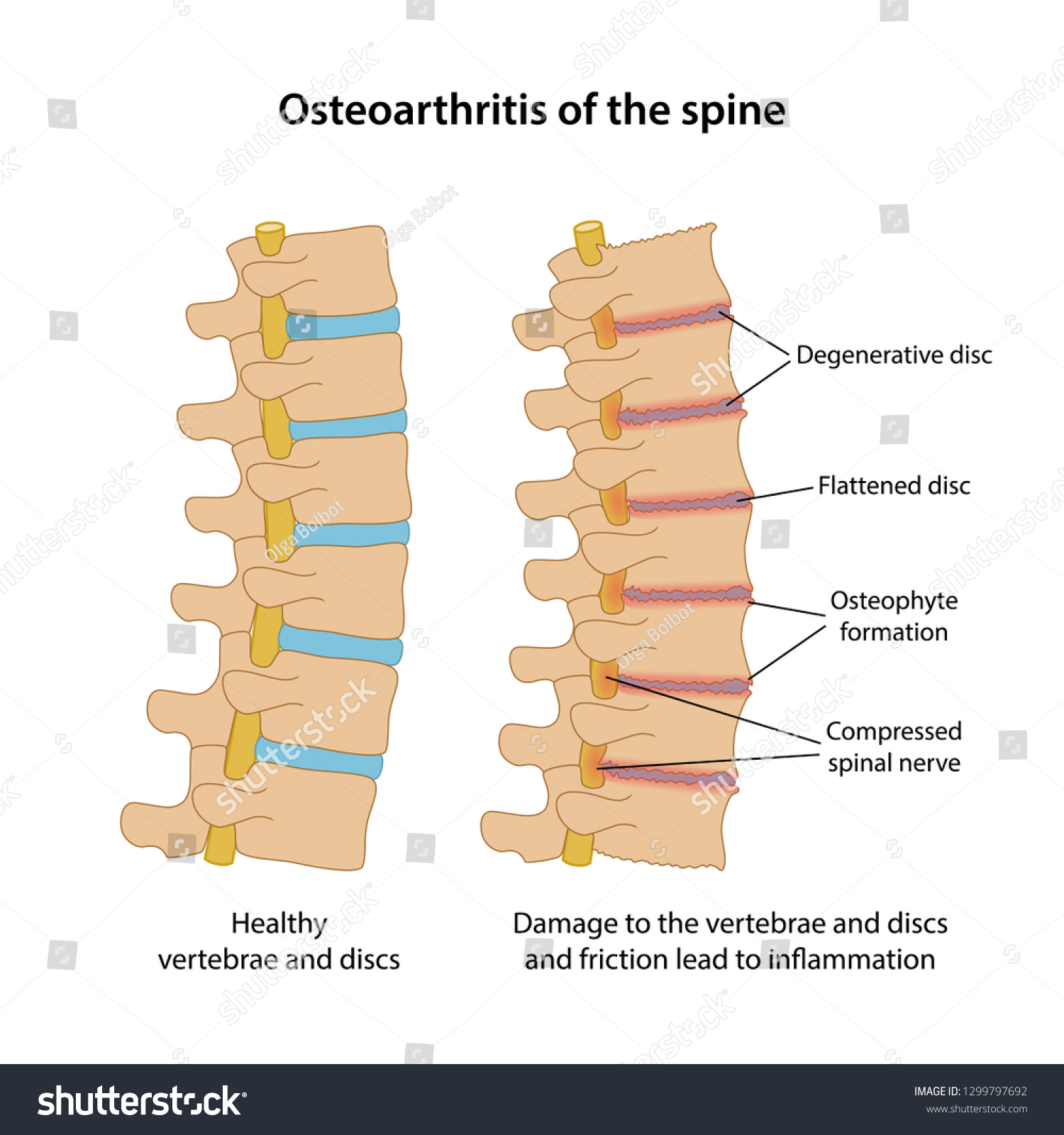 Osteoarthritis Spine Main Description Healthy Spine Stock Vector ...