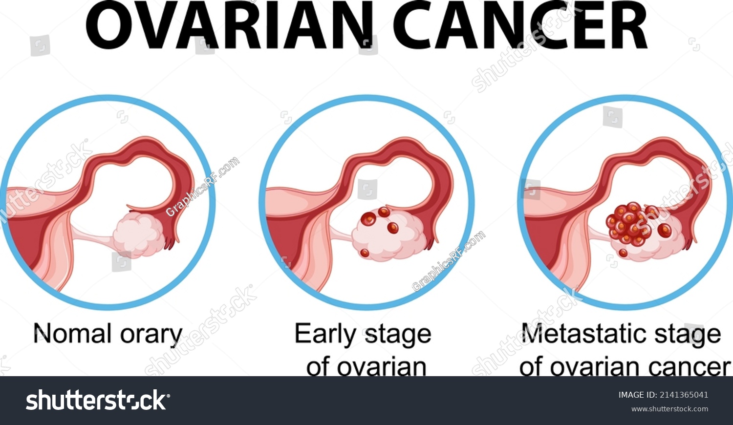 Ovarian Cancer Development Process Infographic Illustration Stock ...