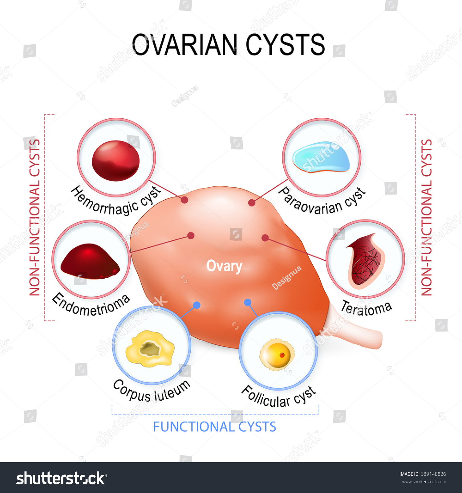 Ovarian Cysts Stock Vector (Royalty Free) 689148826