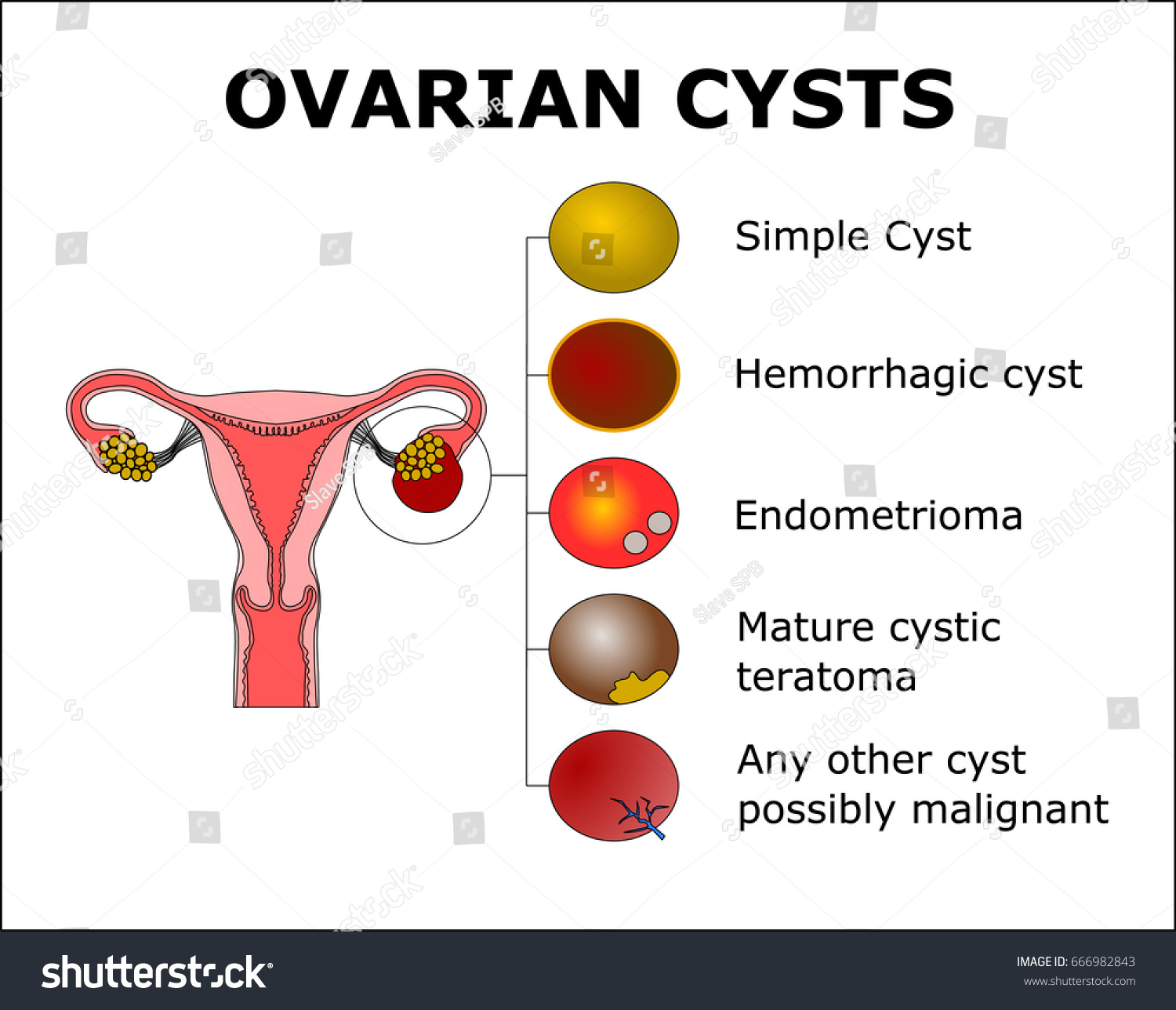 Ovarian Cystscolor Vector Illustration Stock Vector 666982843 ...