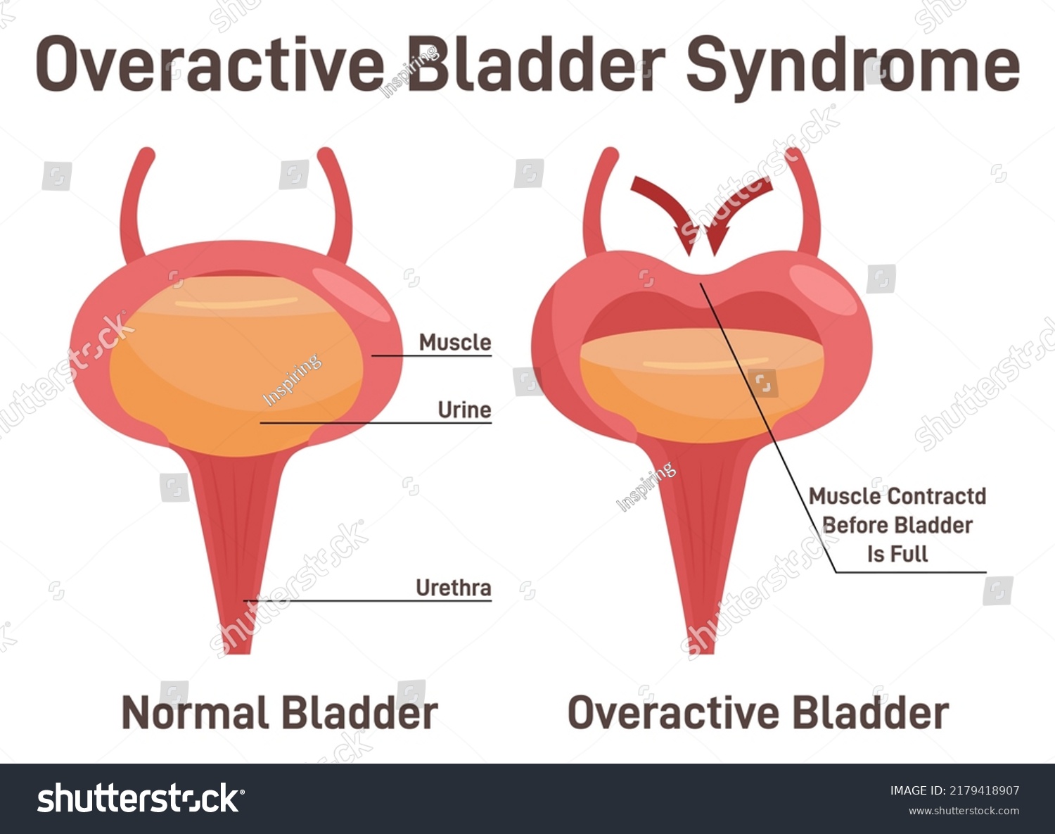 Overactive Bladder Syndrom Normal Bladder Bladder Stock Vector (royalty 