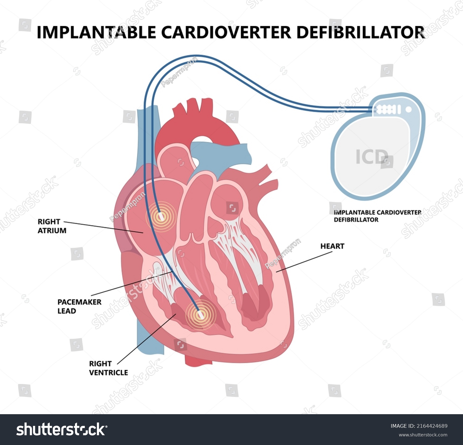 Pacemaker Icd Implantable Cardioverte Defibrillator Pulse Stock Vector ...