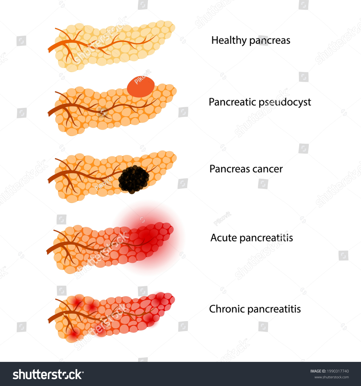 Pancreas Disease Concept Acute Chronic Pancreatitis Vetor Stock Livre De Direitos 1990317740 6246