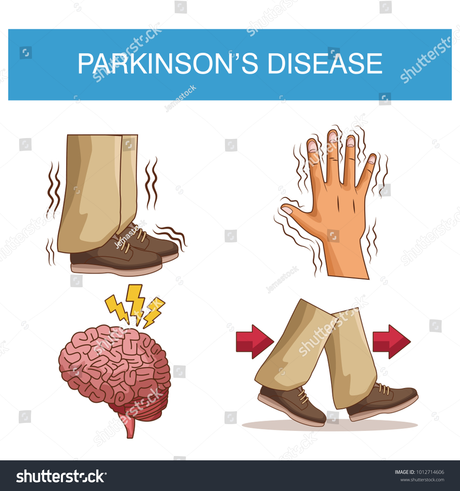 Parkinsons Disease Infographic Stock Vector (Royalty Free) 1012714606