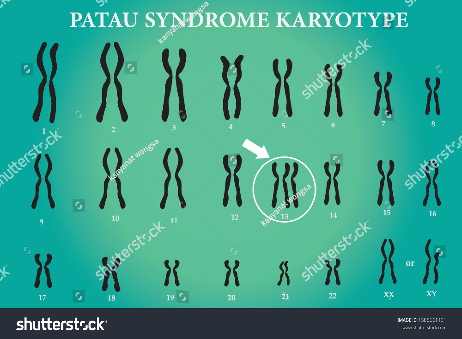 Patau Syndrome Karyotype One Chromosomal Disorders Vector De Stock Libre De Regalías 