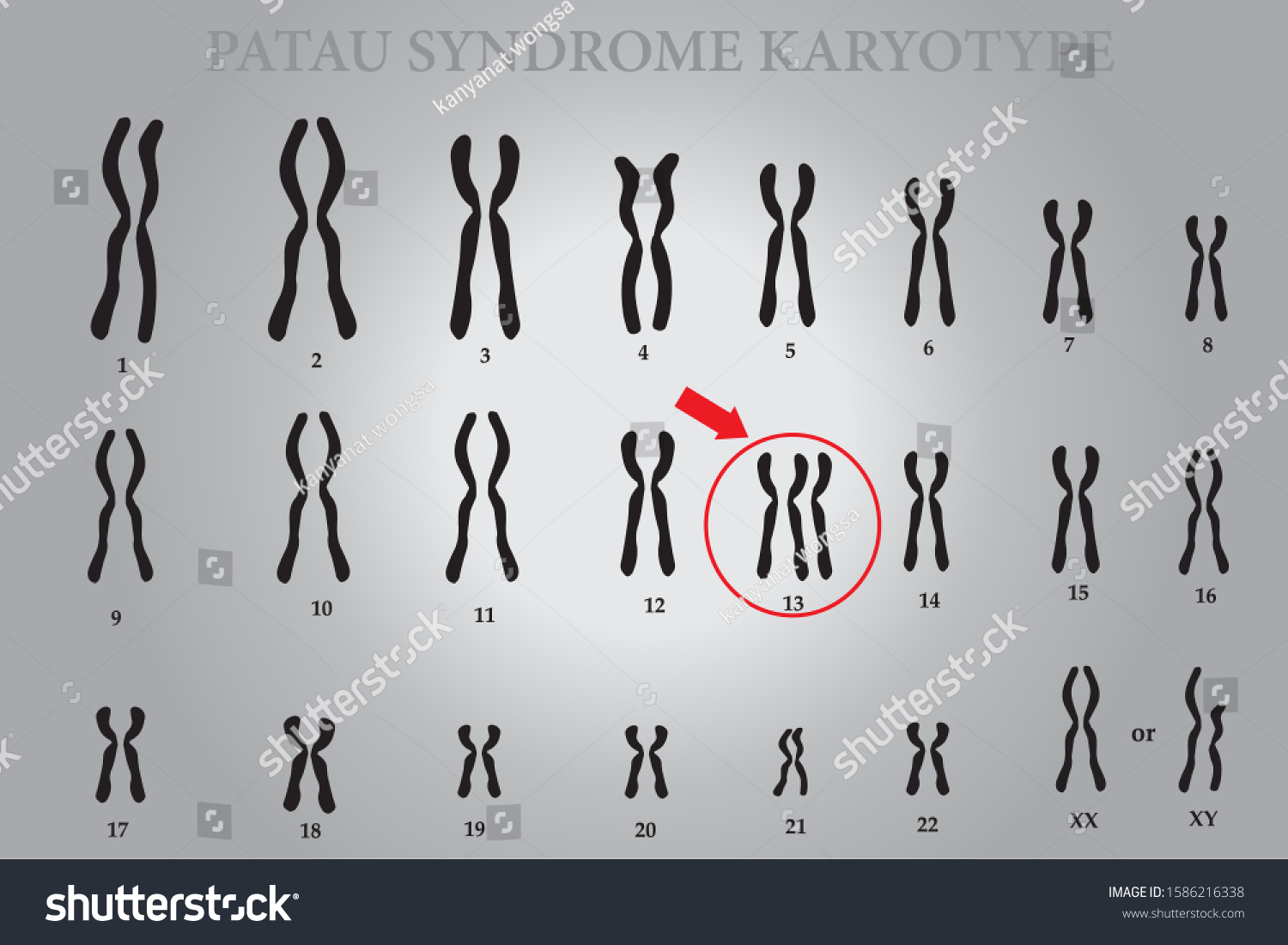 What Race Is Patau Syndrome Common In