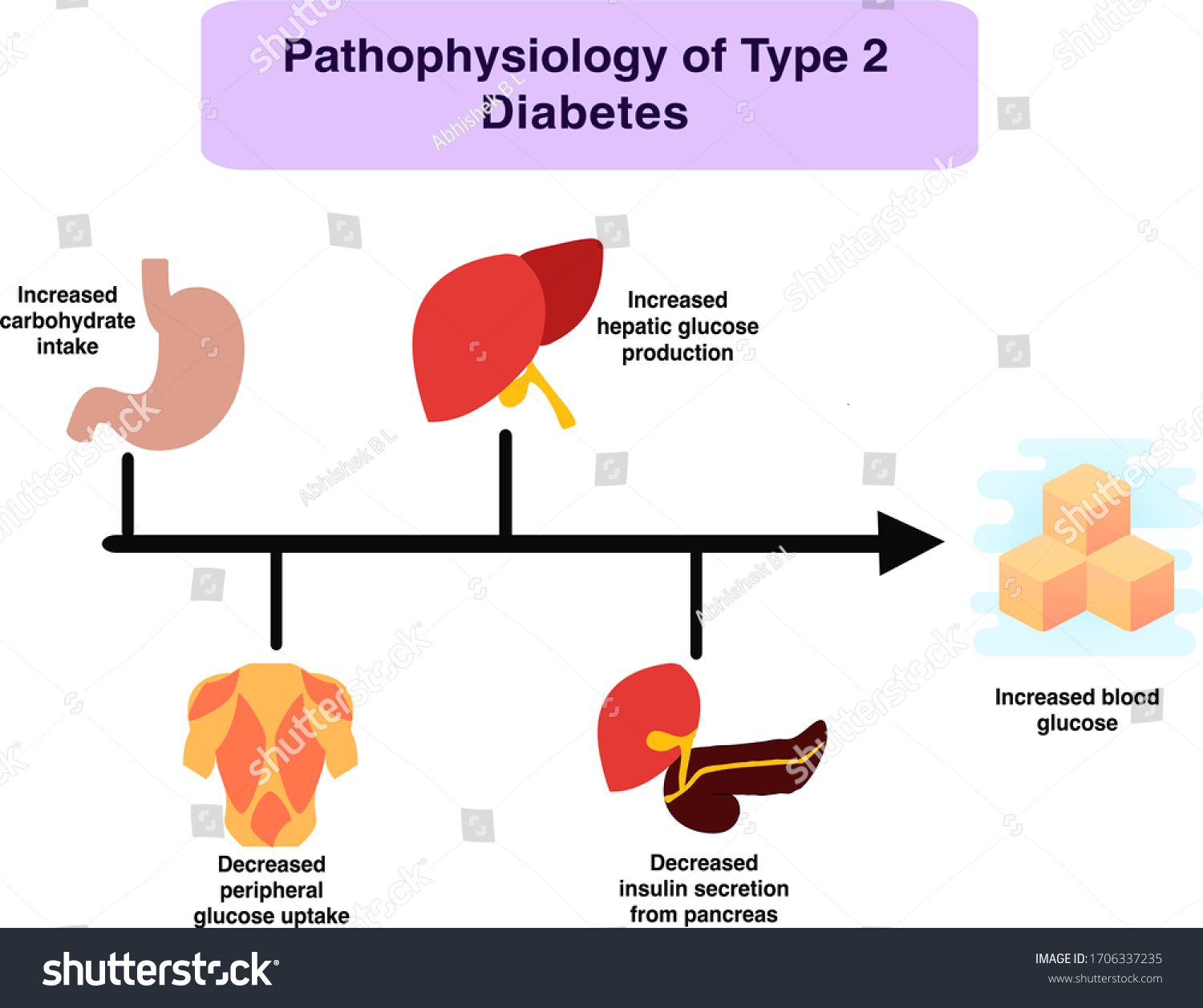 Diabetes mellitus: Pathophysiologie und Mechanismen