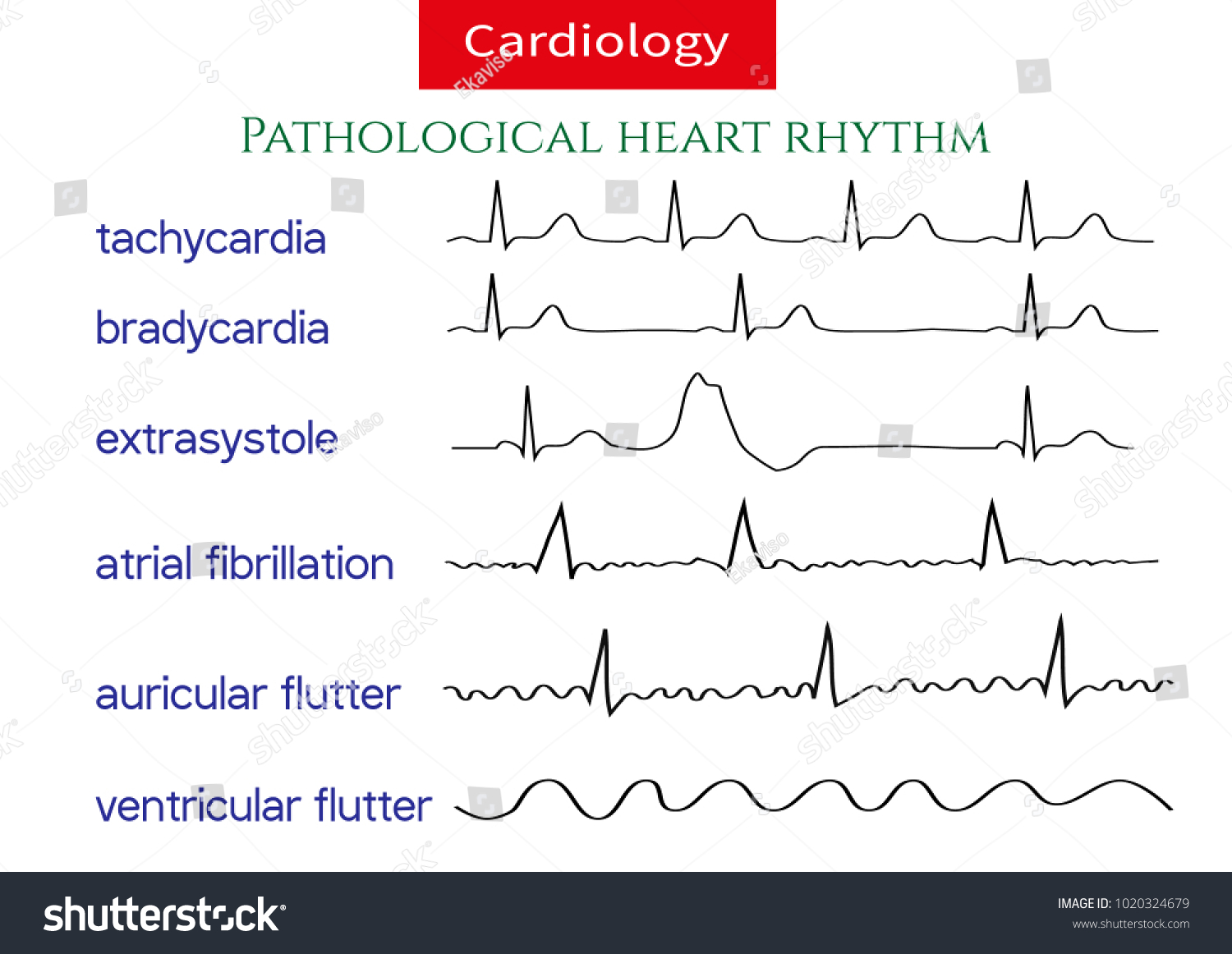 3 562 Ecg Arrhythmia Images Stock Photos Vectors Shutterstock