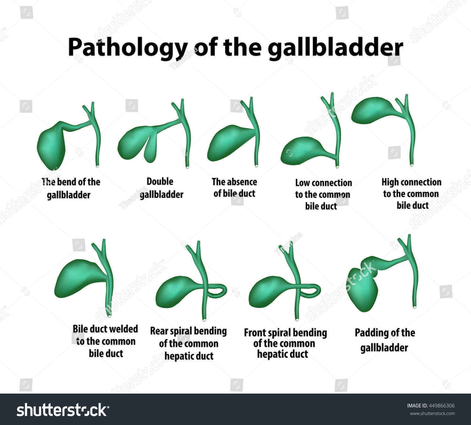 Bend of the gallbladder: causes, clinical manifestations, treatment Bend of the gallbladder: causes, clinical manifestations, treatment