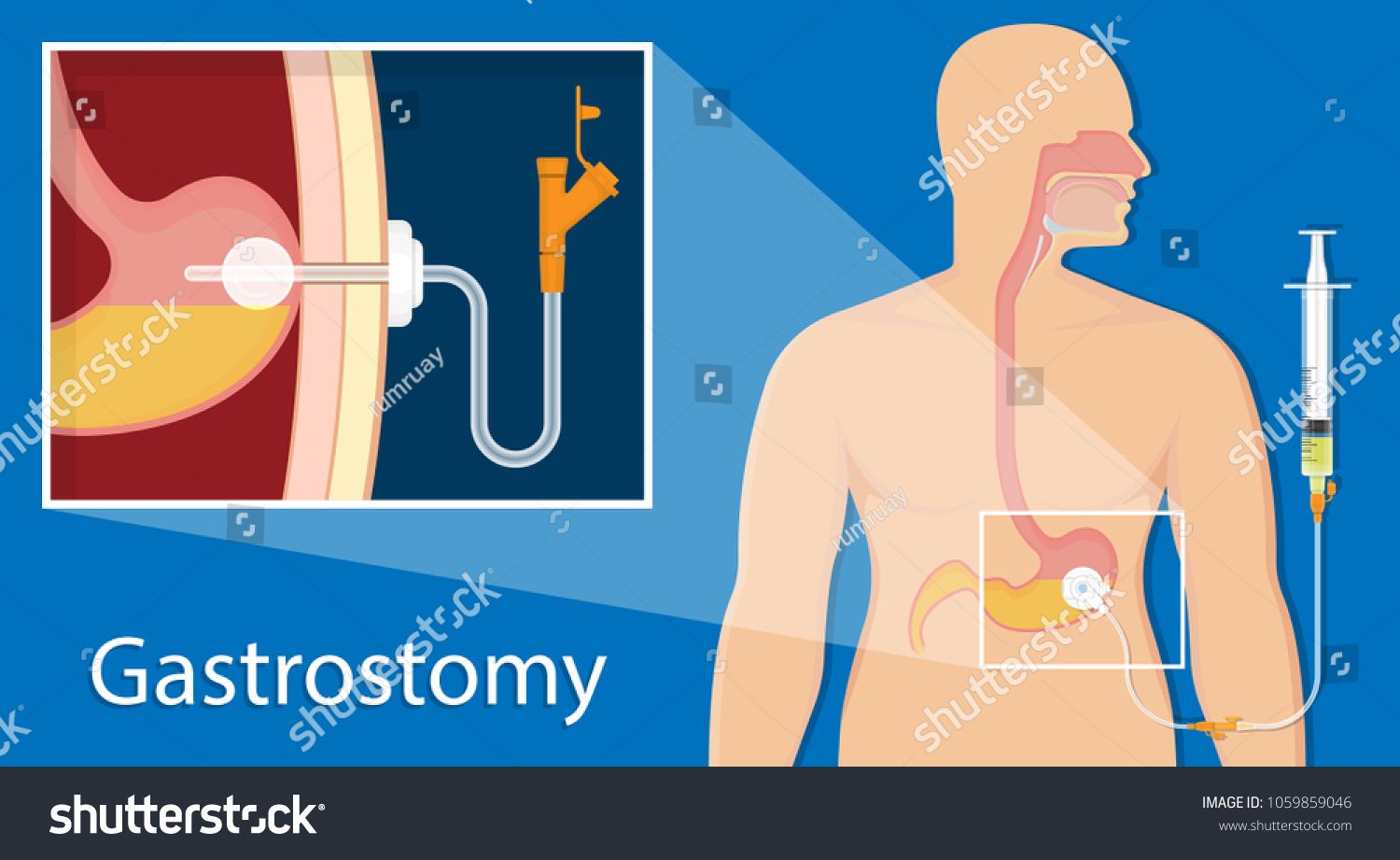 55 Gastrostomy tube Images, Stock Photos & Vectors | Shutterstock