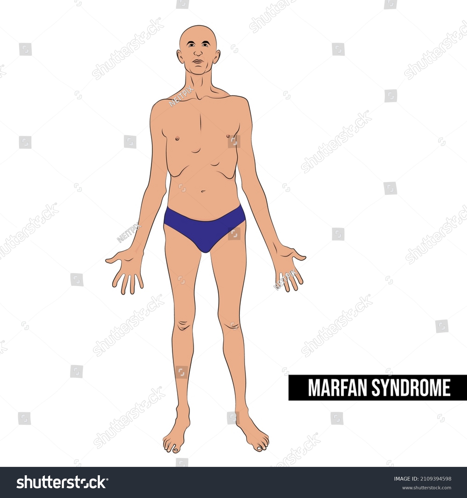 Marfan syndrome