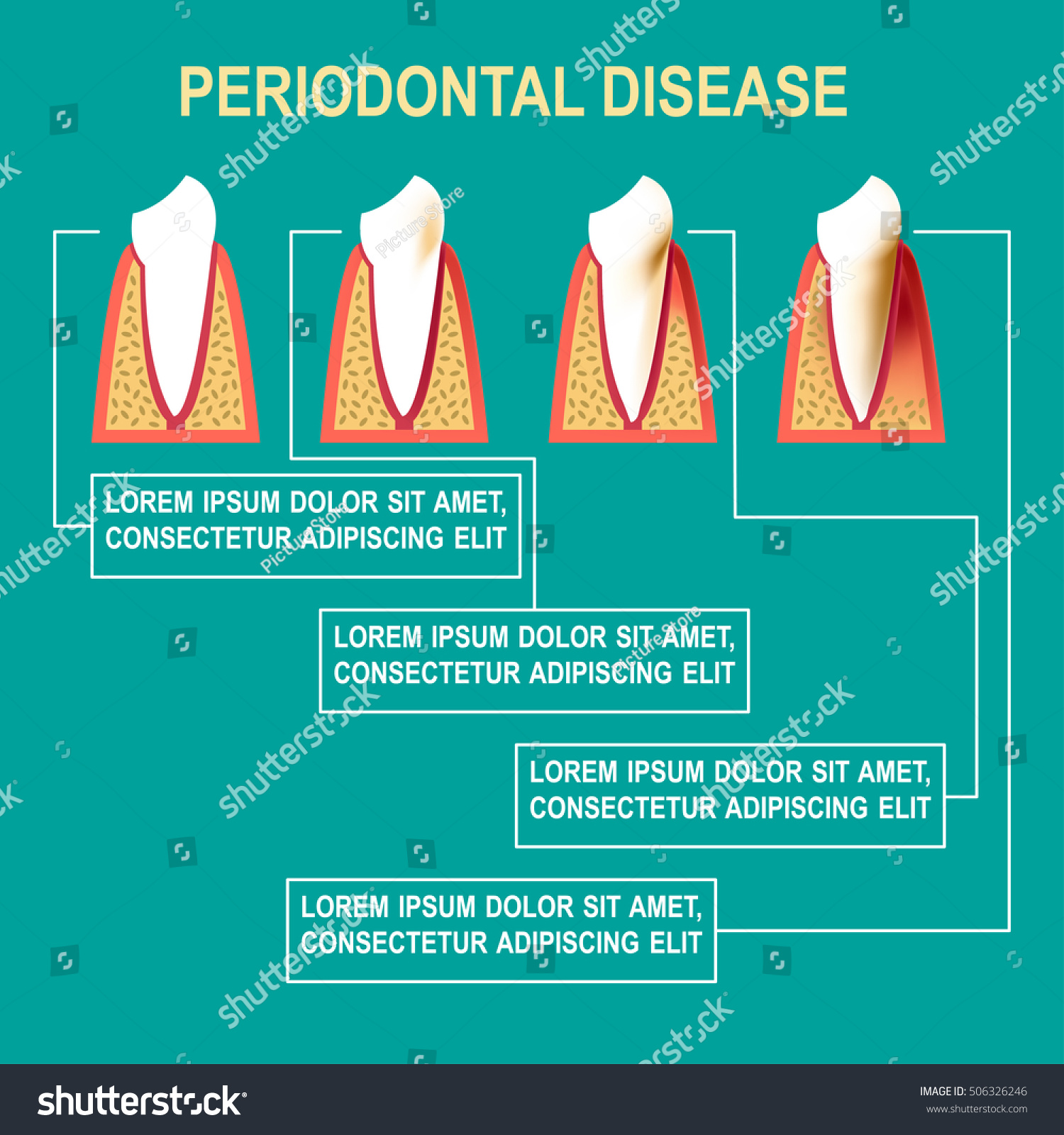 Periodontal Disease Vector Illustration Medical Poster Vector De Stock Libre De Regalías 6843