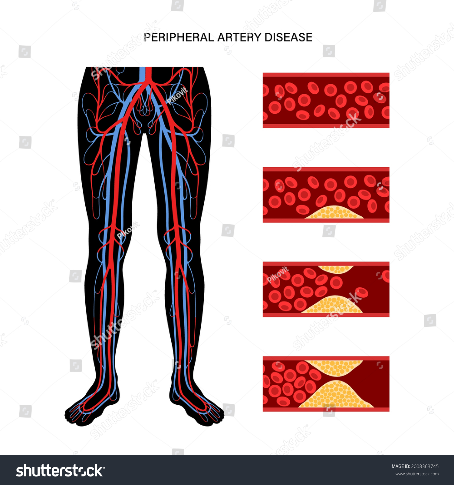 Peripheral Artery Disease Ischemia Leg Cholesterol Stock Vector ...