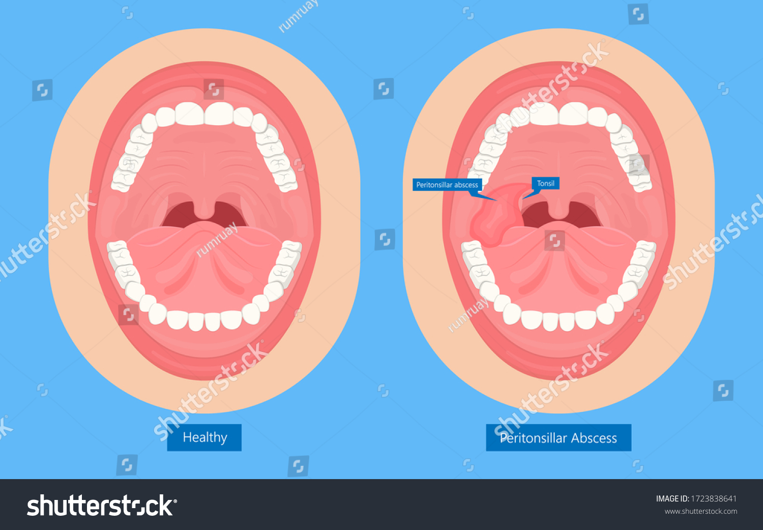 4 Peritonsil Abscess Immagini Foto Stock E Grafica Vettoriale