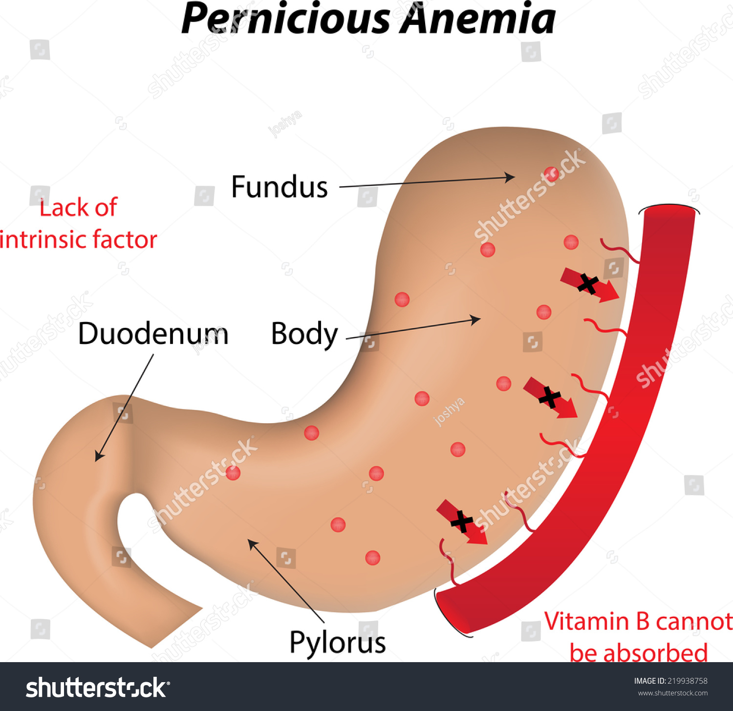 Pernicious Anemia Clip Art – Cliparts