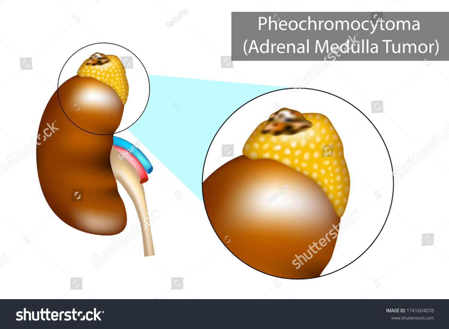 褐色細胞腫 Phまたはpcc 副腎腫瘍 のベクター画像素材 ロイヤリティフリー