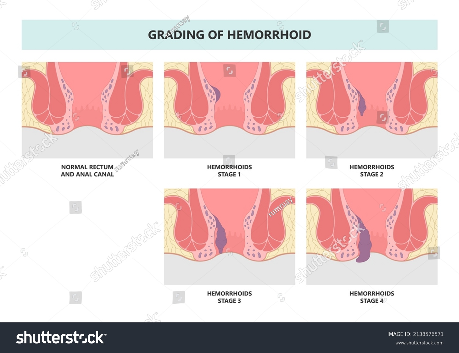 Piles Swollen Blood Anus Treat Band Stock Vector (Royalty Free) 2138576571