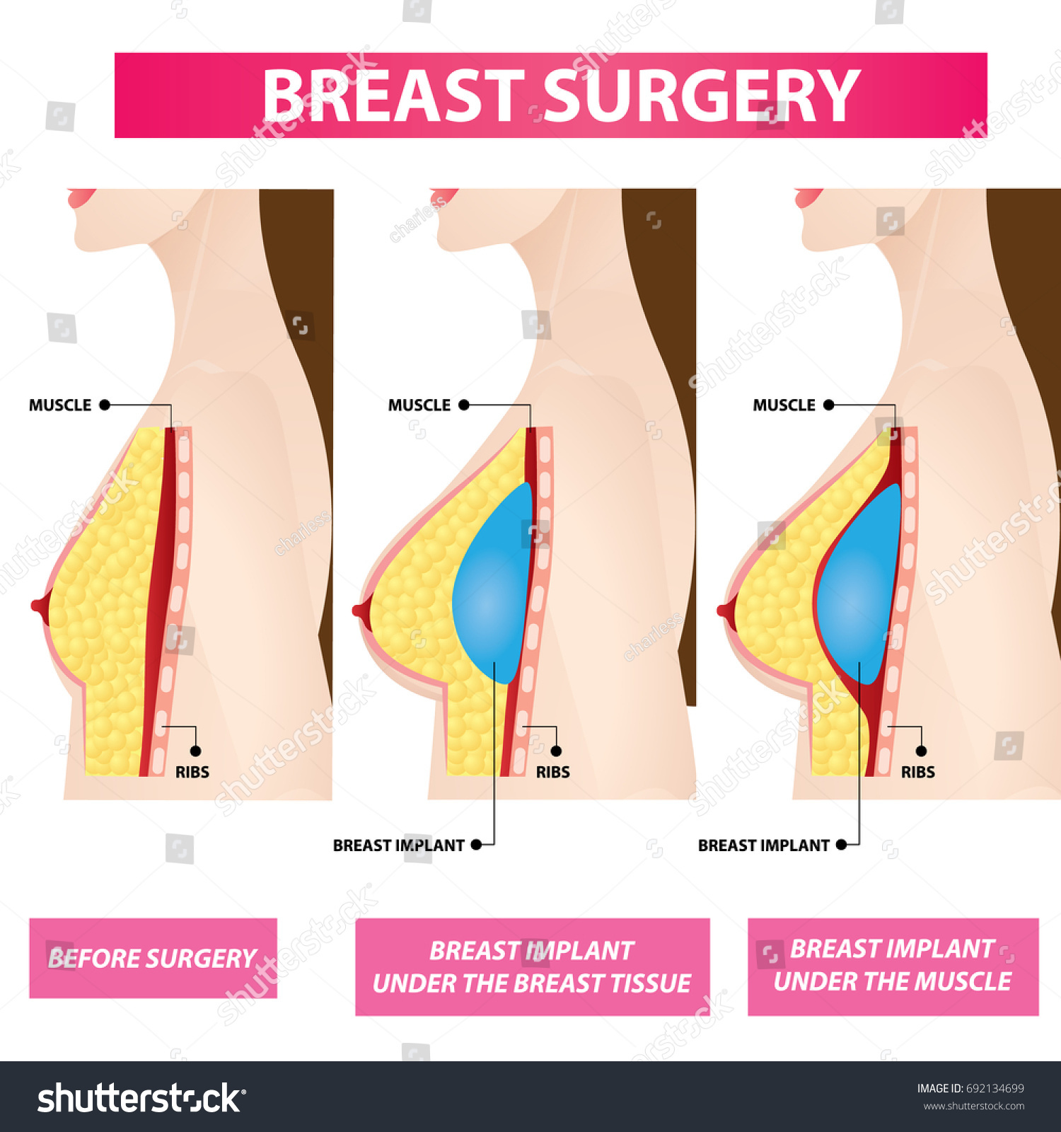 Breast Implant Chart