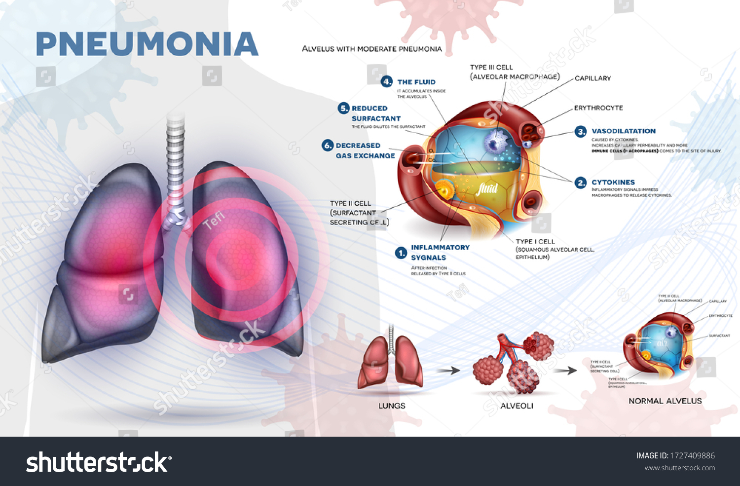 Vektor Stok Pneumonia Explained Info Poster Body Immune Tanpa Royalti 1727409886 Shutterstock 2087