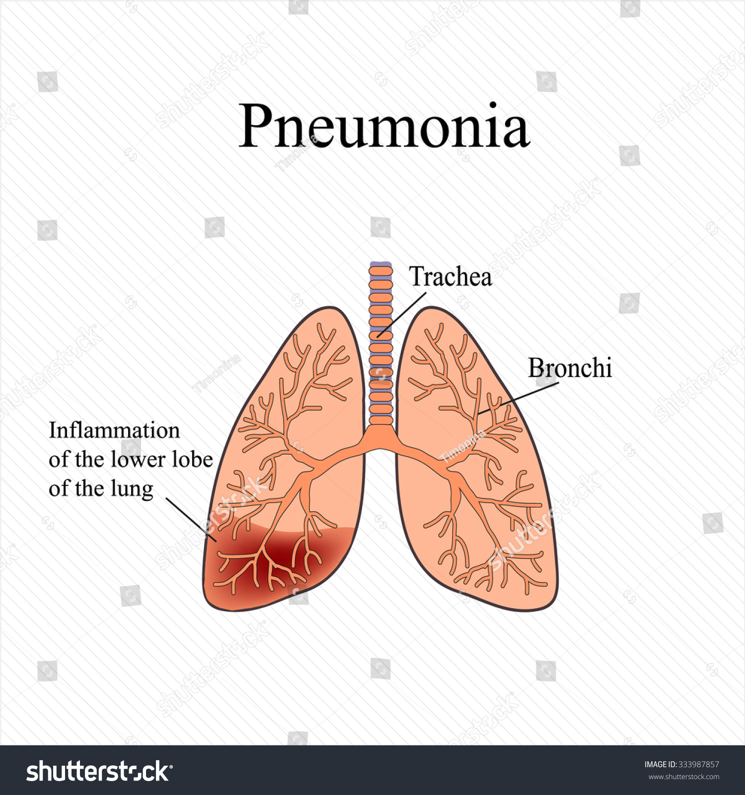 Pneumonia. The Anatomical Structure Of The Human Lung. Inflammation Of ...