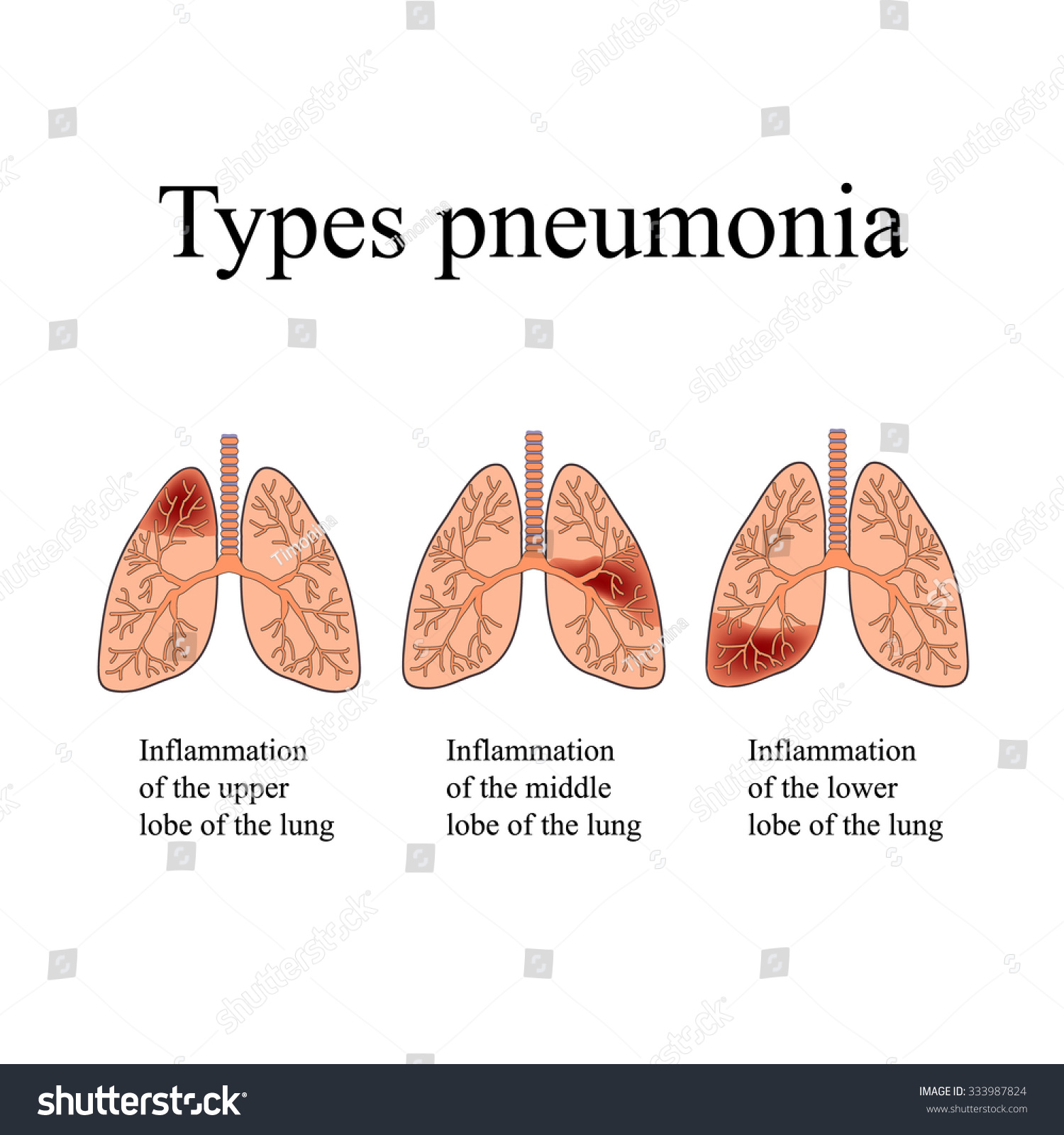 Pneumonia Diagram