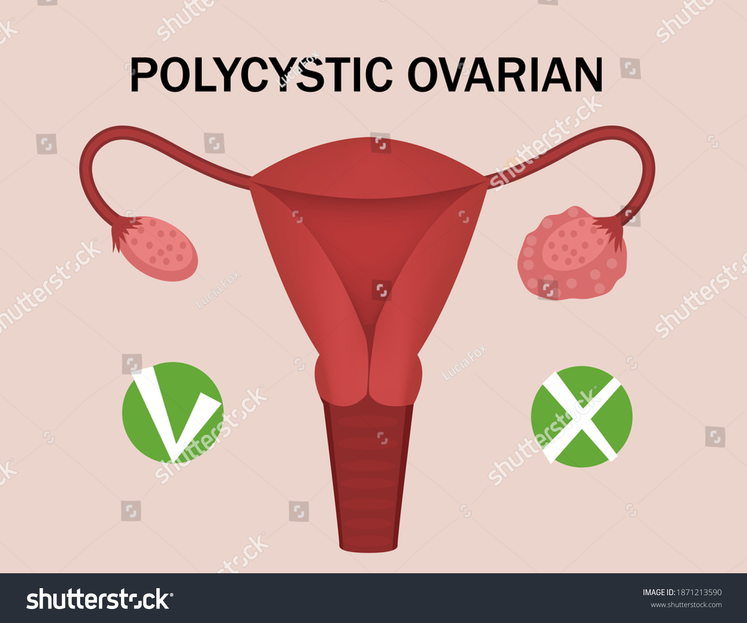 Polycystic Ovary Disease Healthy Ovary Medical Stock Vector (Royalty ...